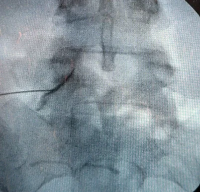Fluoroscopic image of a transforaminal epidural steroid injection.