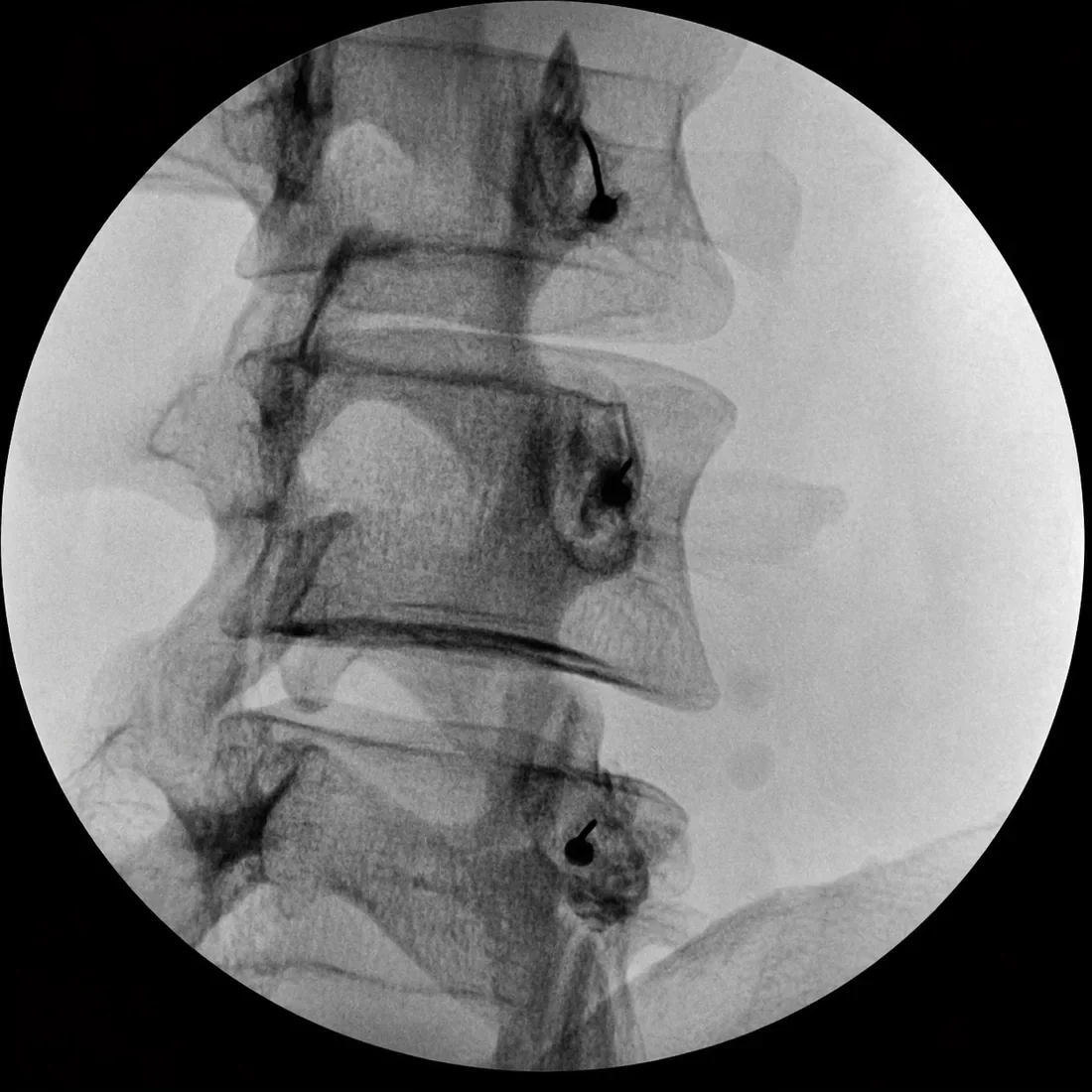 Fluoroscopic view of medial branch blocks.