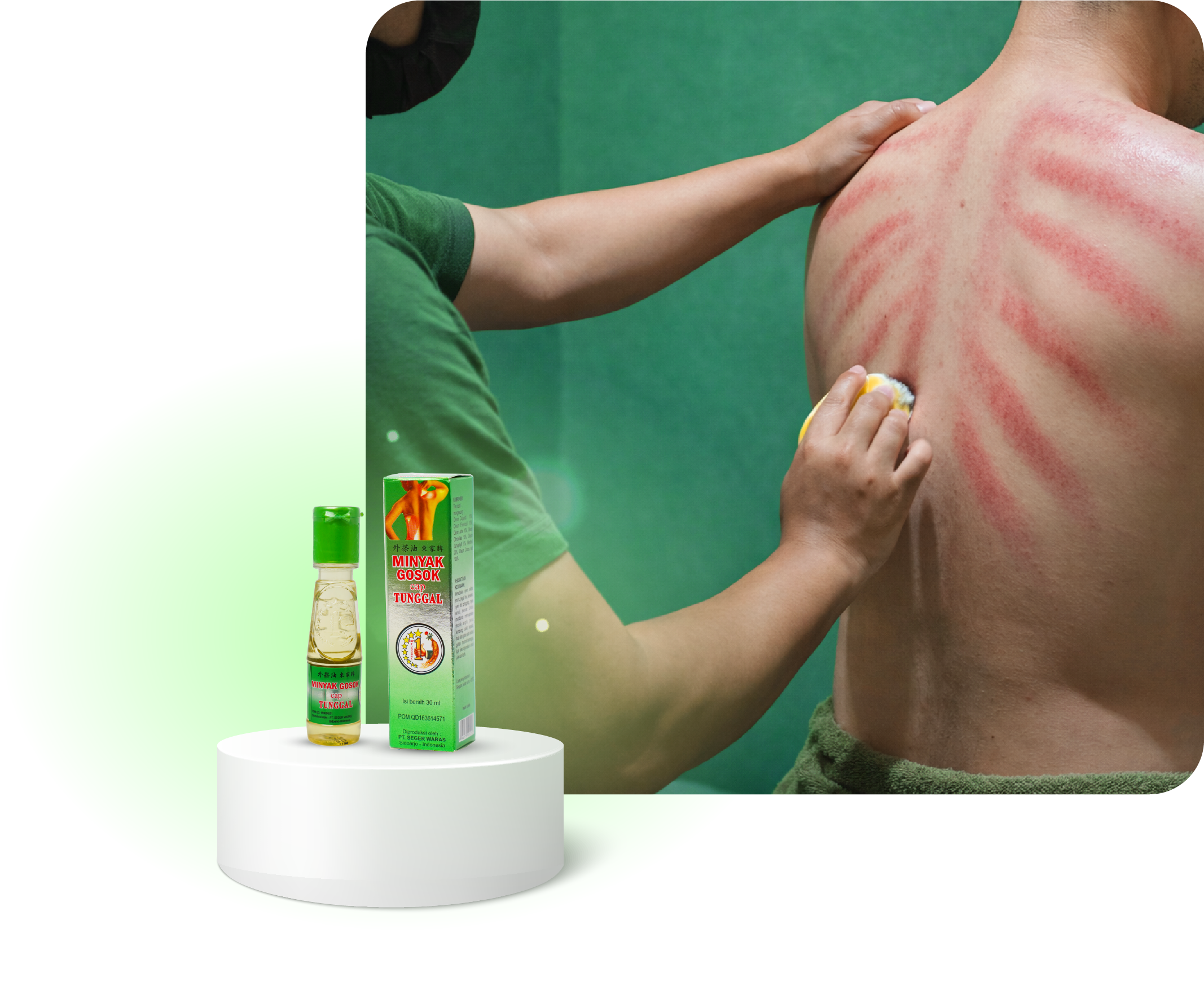 A person with tanned skin and a green towel on their waist has red rash on their shoulder and upper back. Another person, wearing a green shirt, is applying a yellowish ointment to the rash. In the foreground, there are two small bottles of herbal ointment, one with a green cap and the other with a green lid, and a green box with red and black text.
