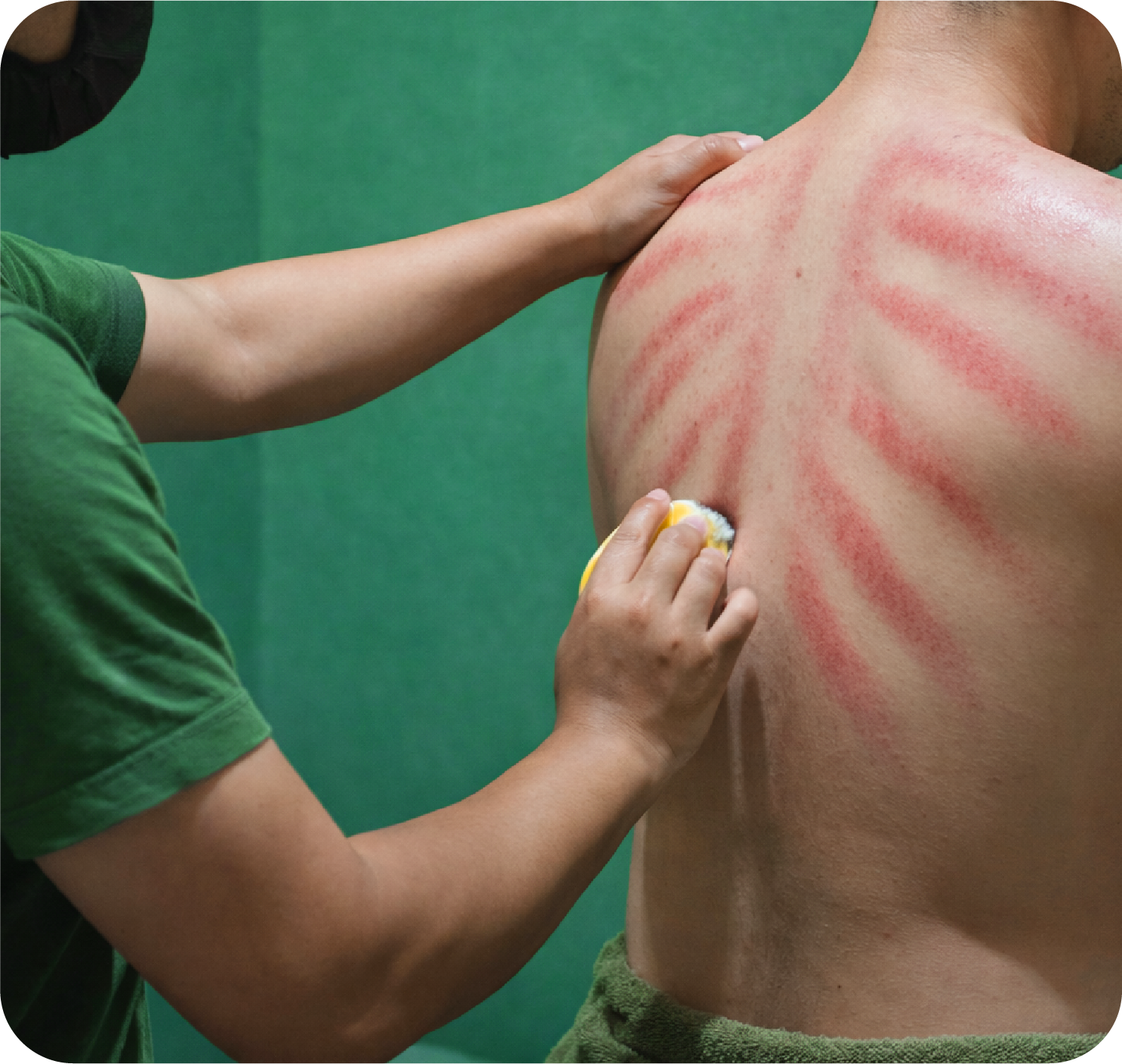 Person with a reddened back from a massage, receiving a massage with a sponge or brush from a therapist wearing a green shirt, in an indoor setting with a green background.