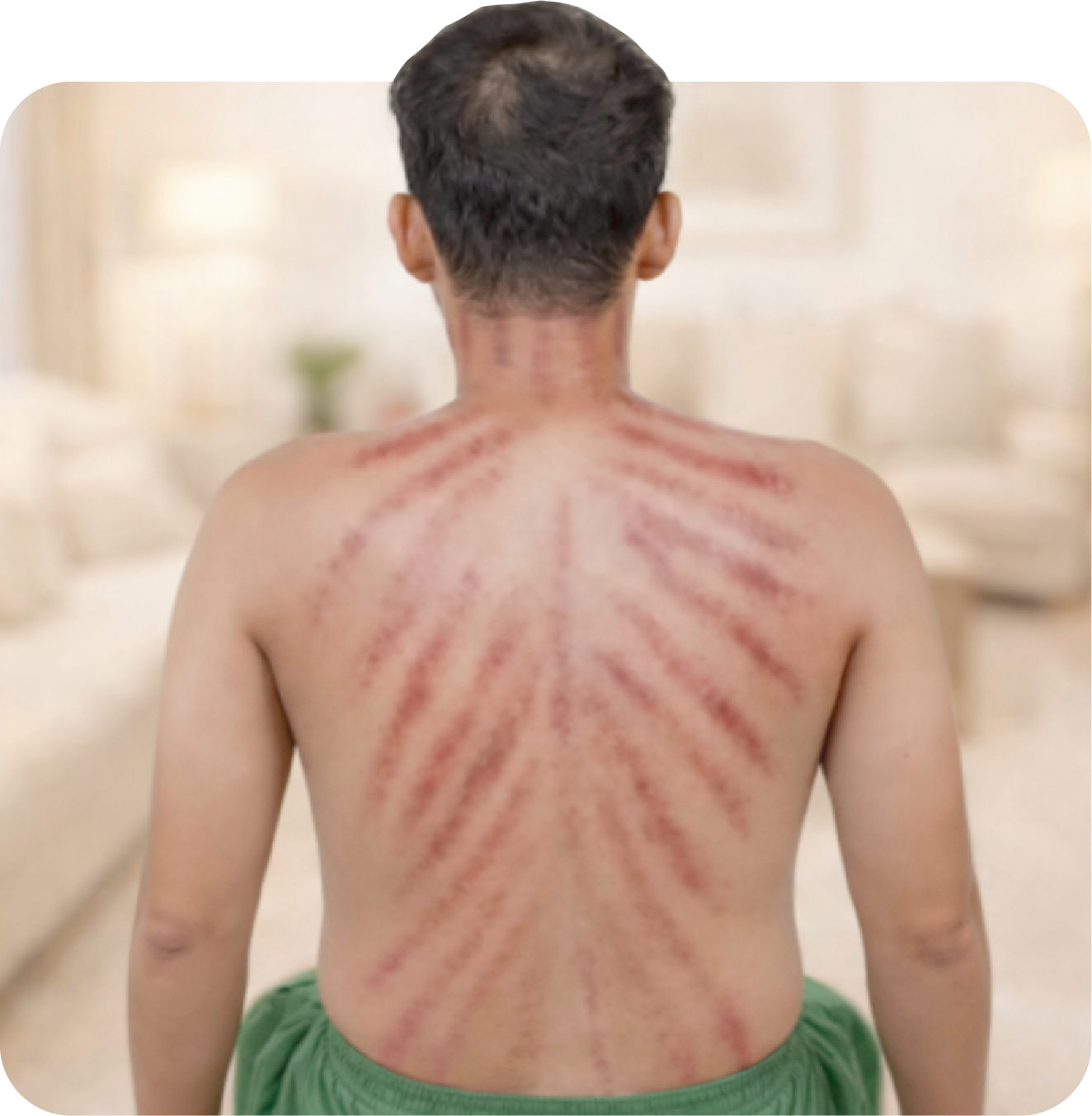 A young man with short dark hair, sitting shirtless on a bed, displaying red stretch marks across his back and shoulders.