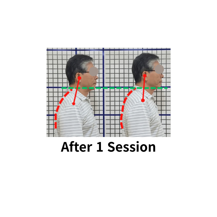 posture correction After 1 Session.png