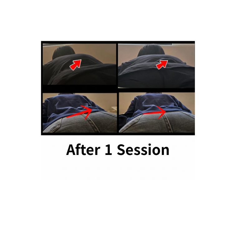 posture correction After 1 Session (1).png