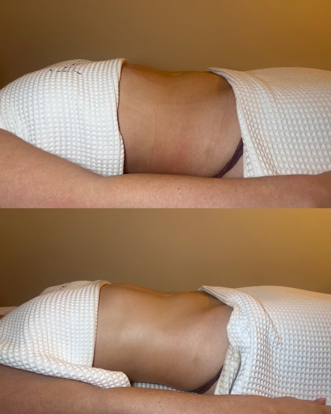 Bloating is often what brings people through the door for their first lymphatic massage. 🤍

That uncomfortable feeling of a swollen stomach, water retention, heavy legs or feeling puffy all over can leave you feeling frustrated, especially when you&