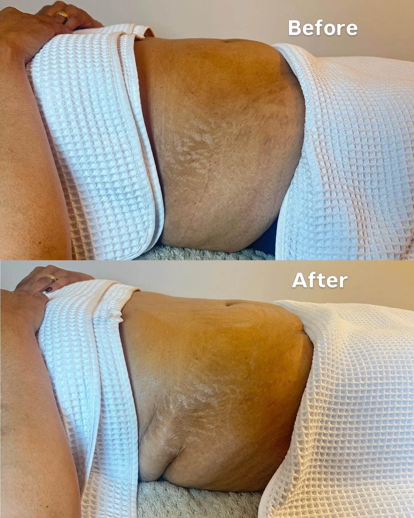BRAZILIAN SCULPTING &amp; WOOD THERAPY✨

Results after just one session 👏🏼

This treatment is designed to help contour and define the body by targeting areas of stubborn fat, bloating and fluid retention while improving the appearance of cellulite.