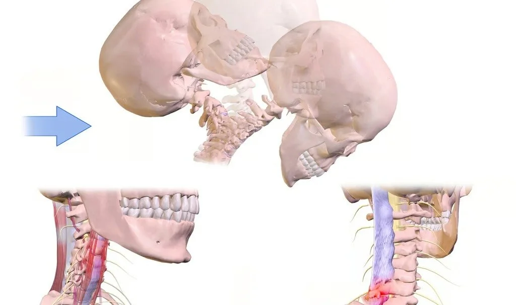 3 Signs You May Need Whiplash Treatments