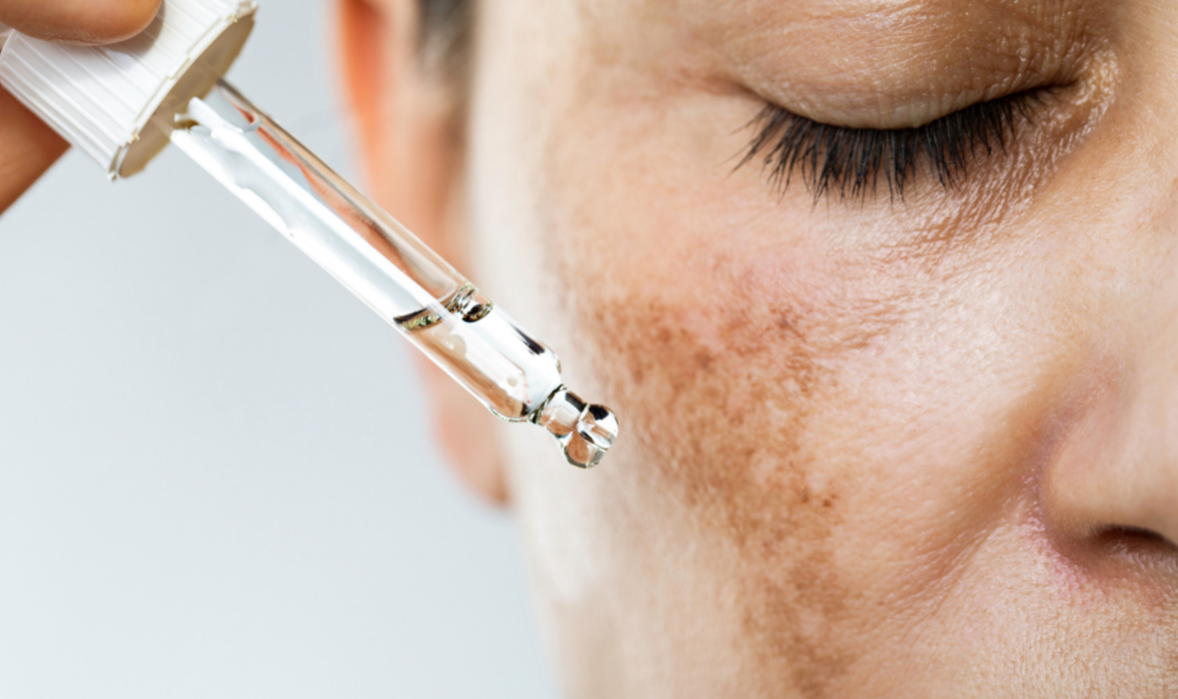 Understanding Hyperpigmentation: Causes, Treatments, and Prevention