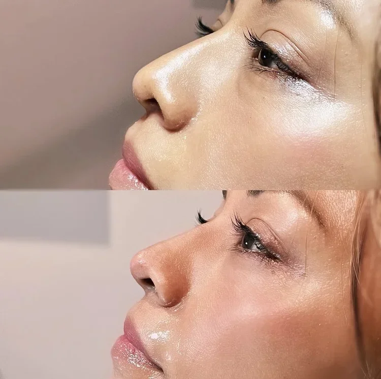 Liquid Rhinoplasty