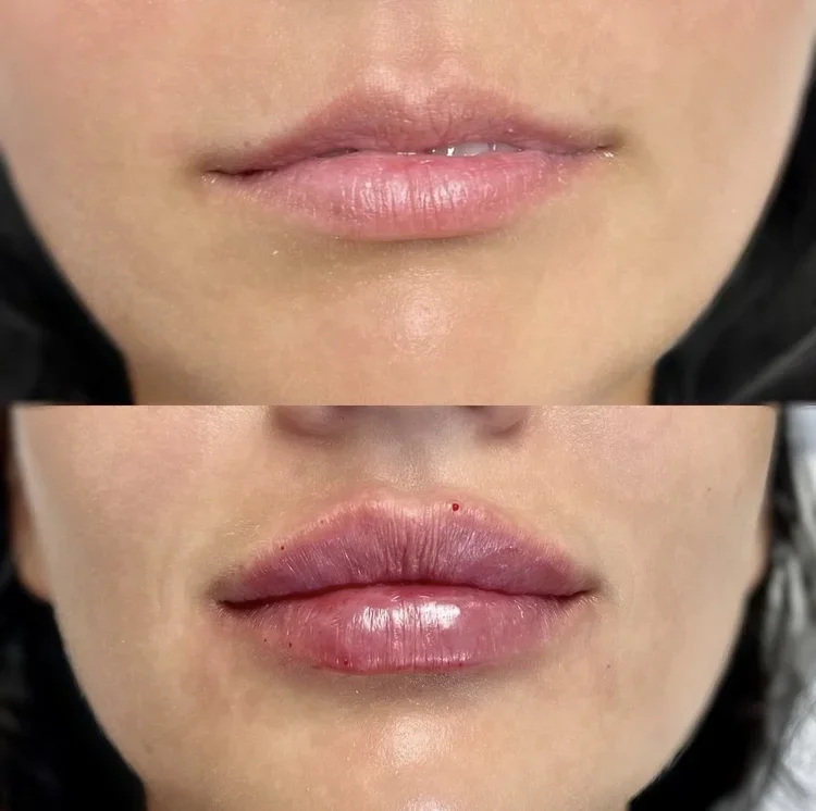 Lip Filler- 2 sessions