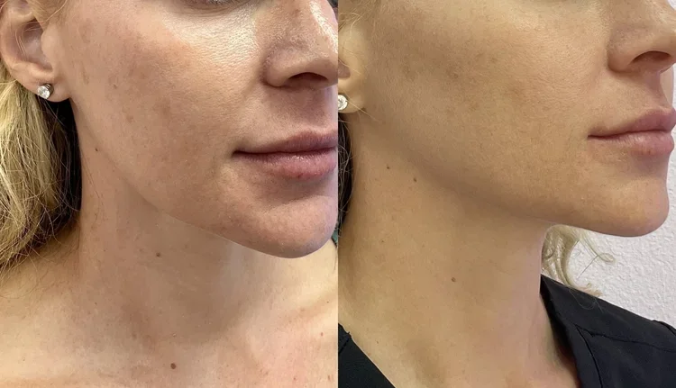 Nefertiti Neck Lift with Neuromodulator