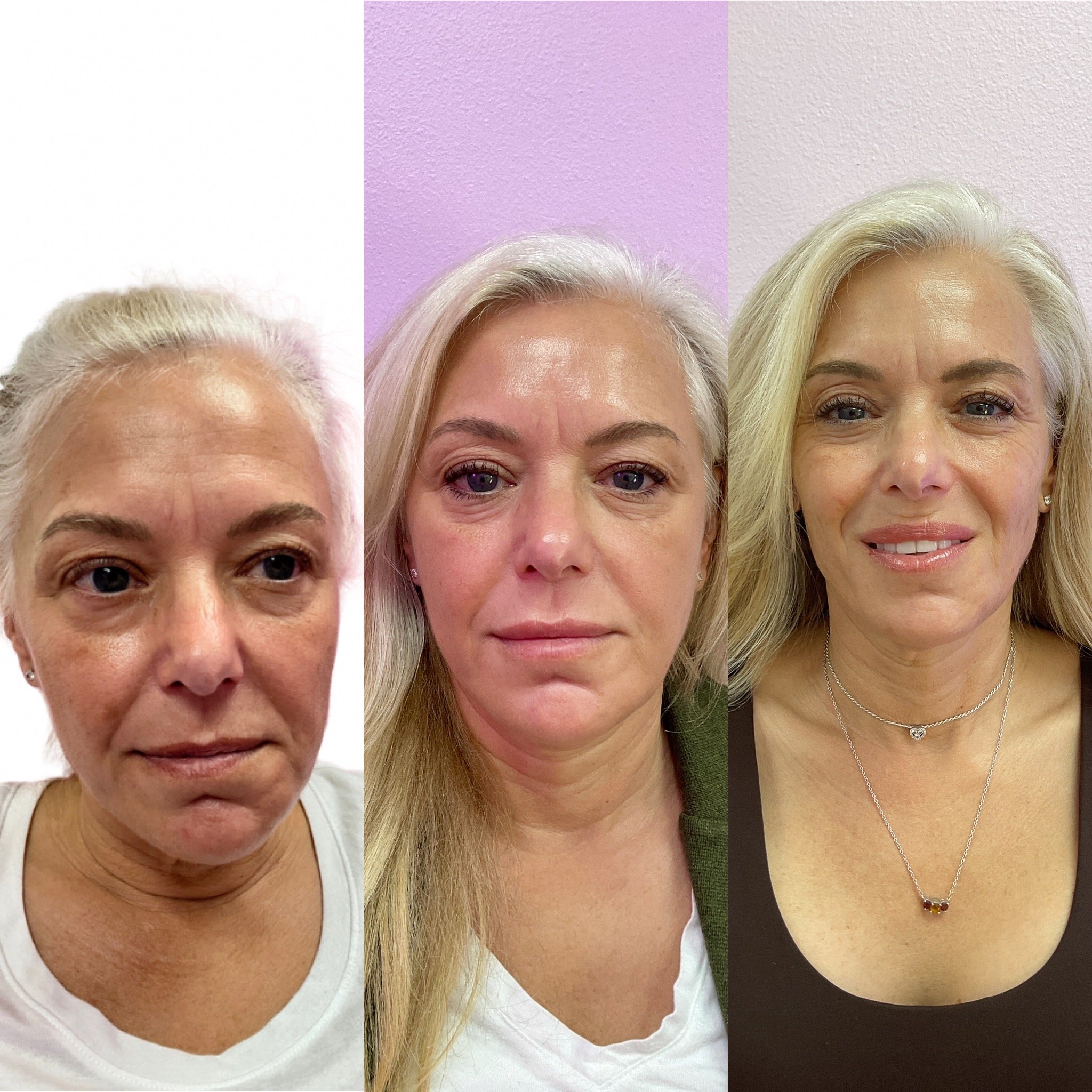 Facial Balancing, Laser &amp; Microneedling
