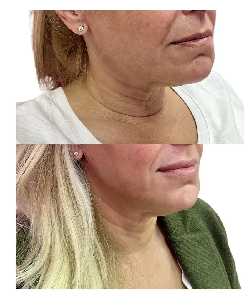 RF Microneedling Neck Tightening