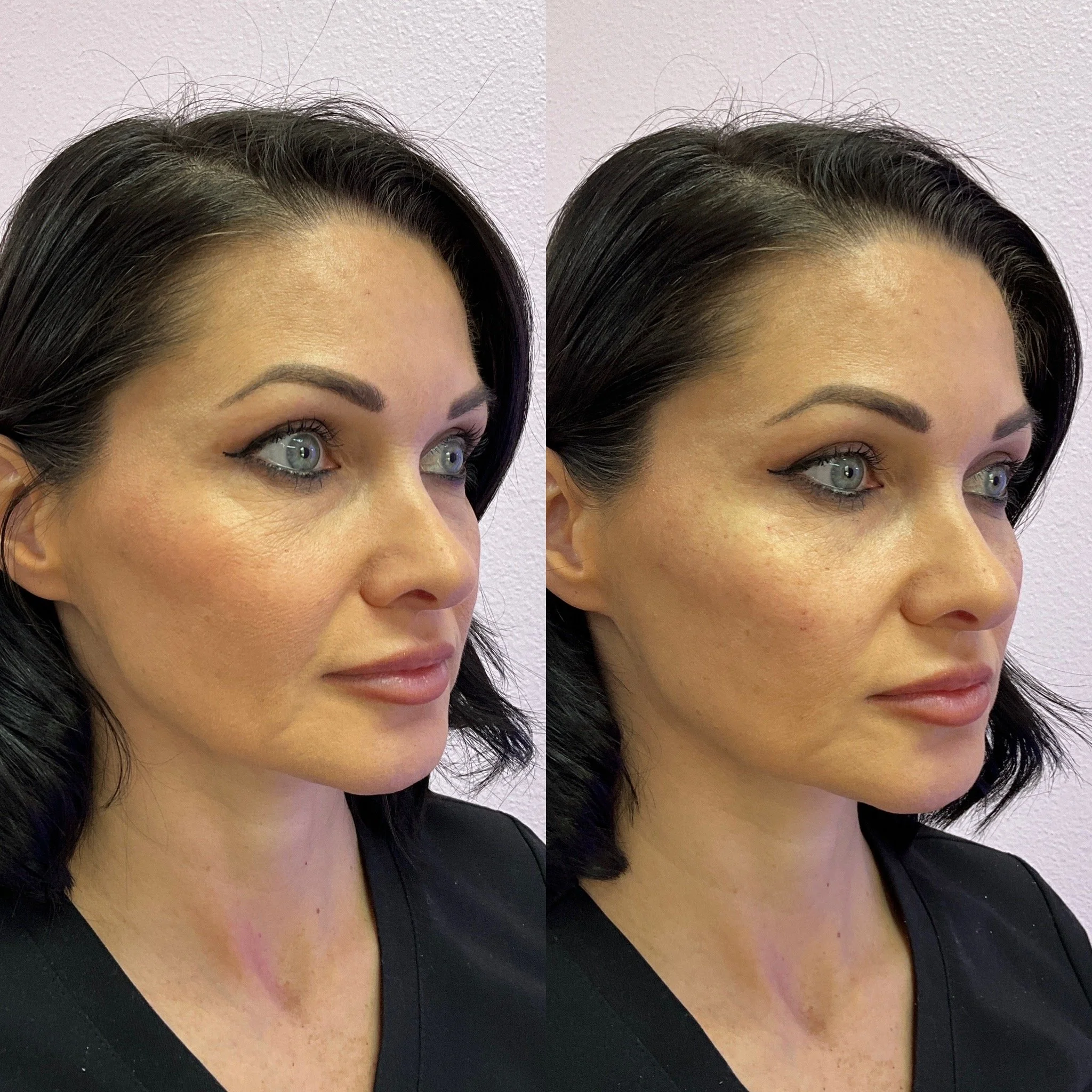 Undereye Filler