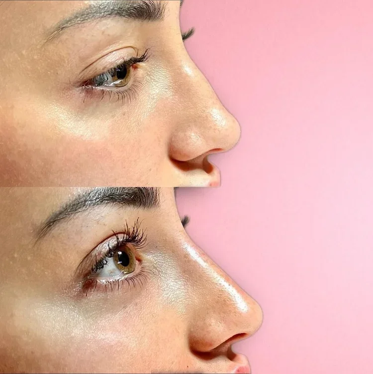 Liquid Rhinoplasty