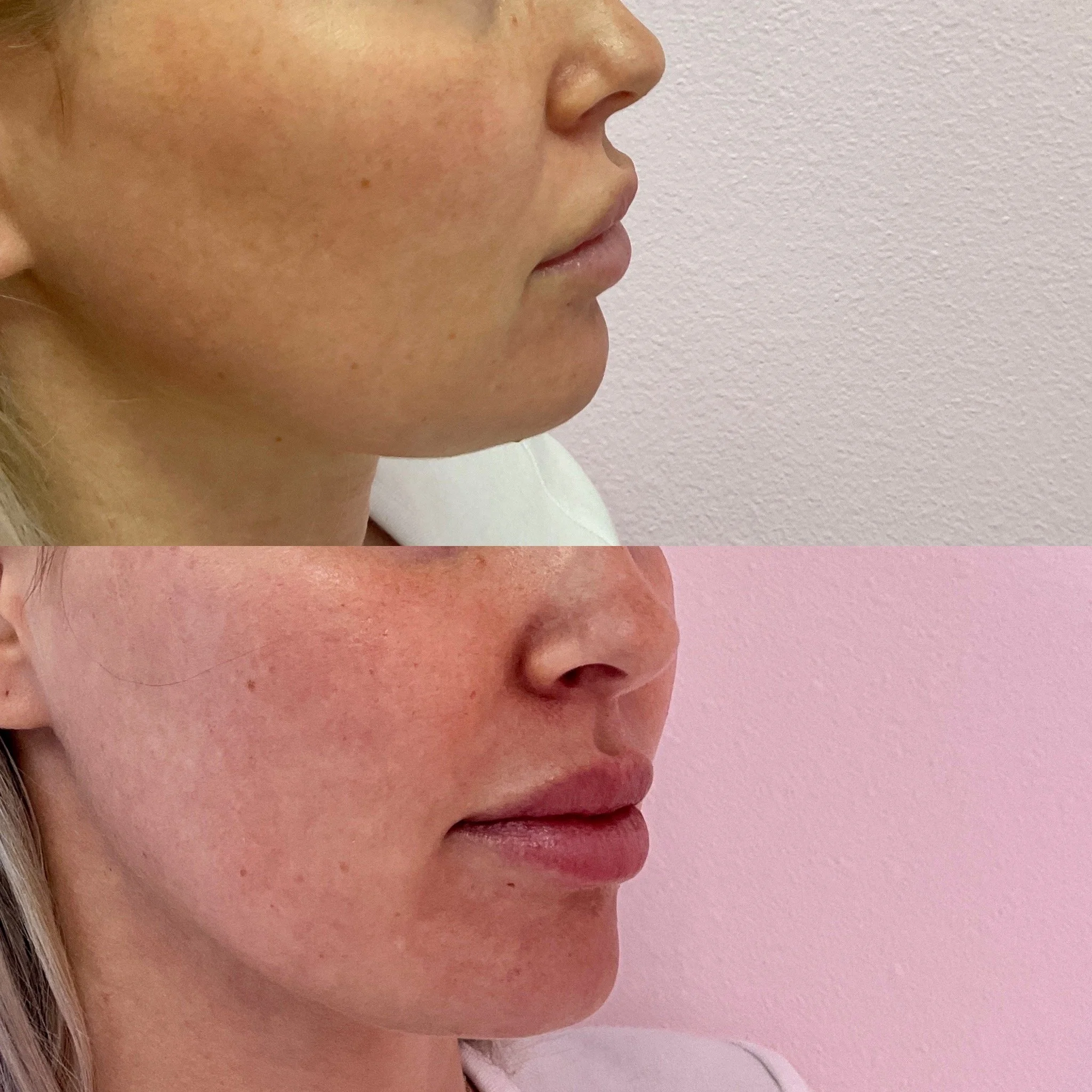 Lip Migration Dissolve