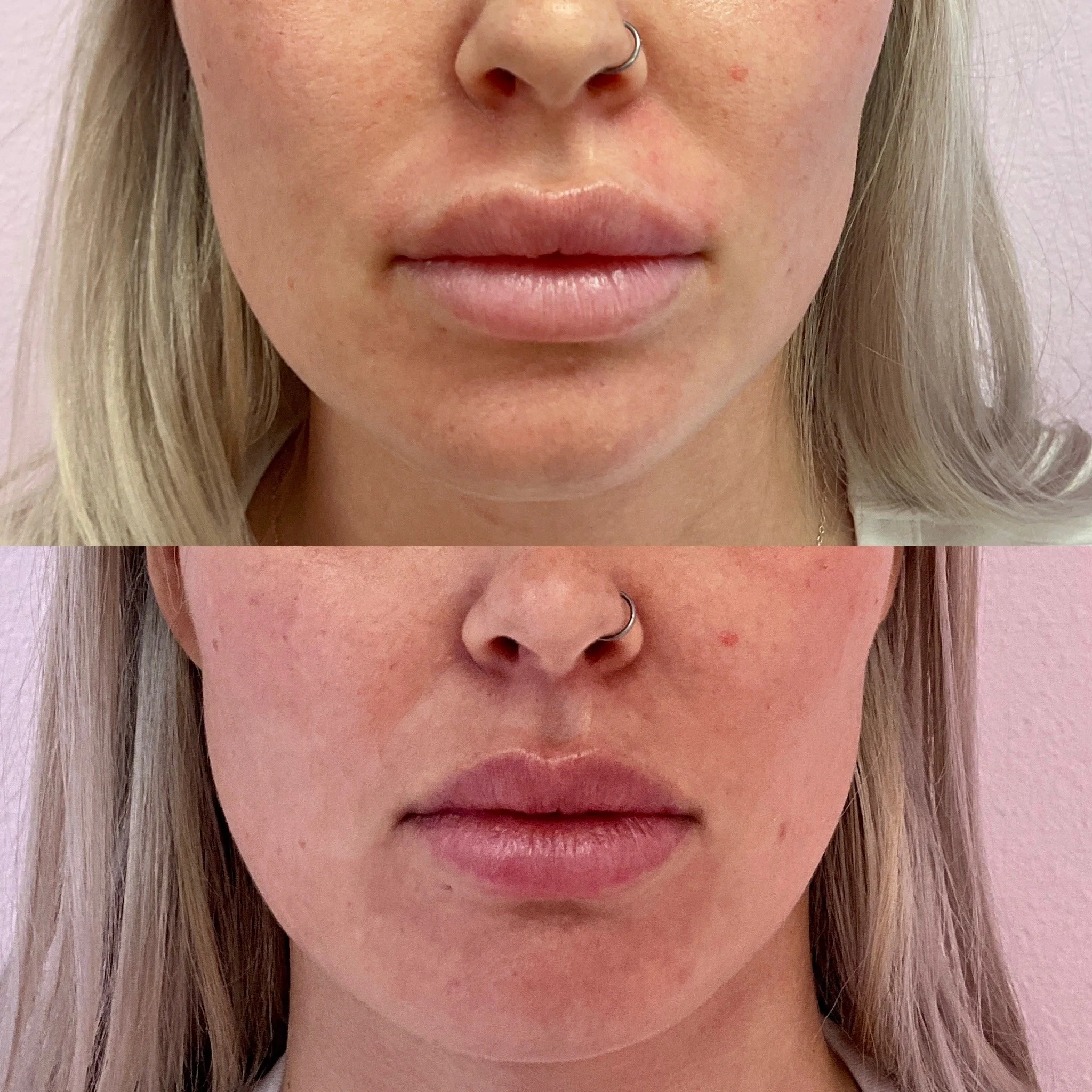 Lip Migration Dissolve