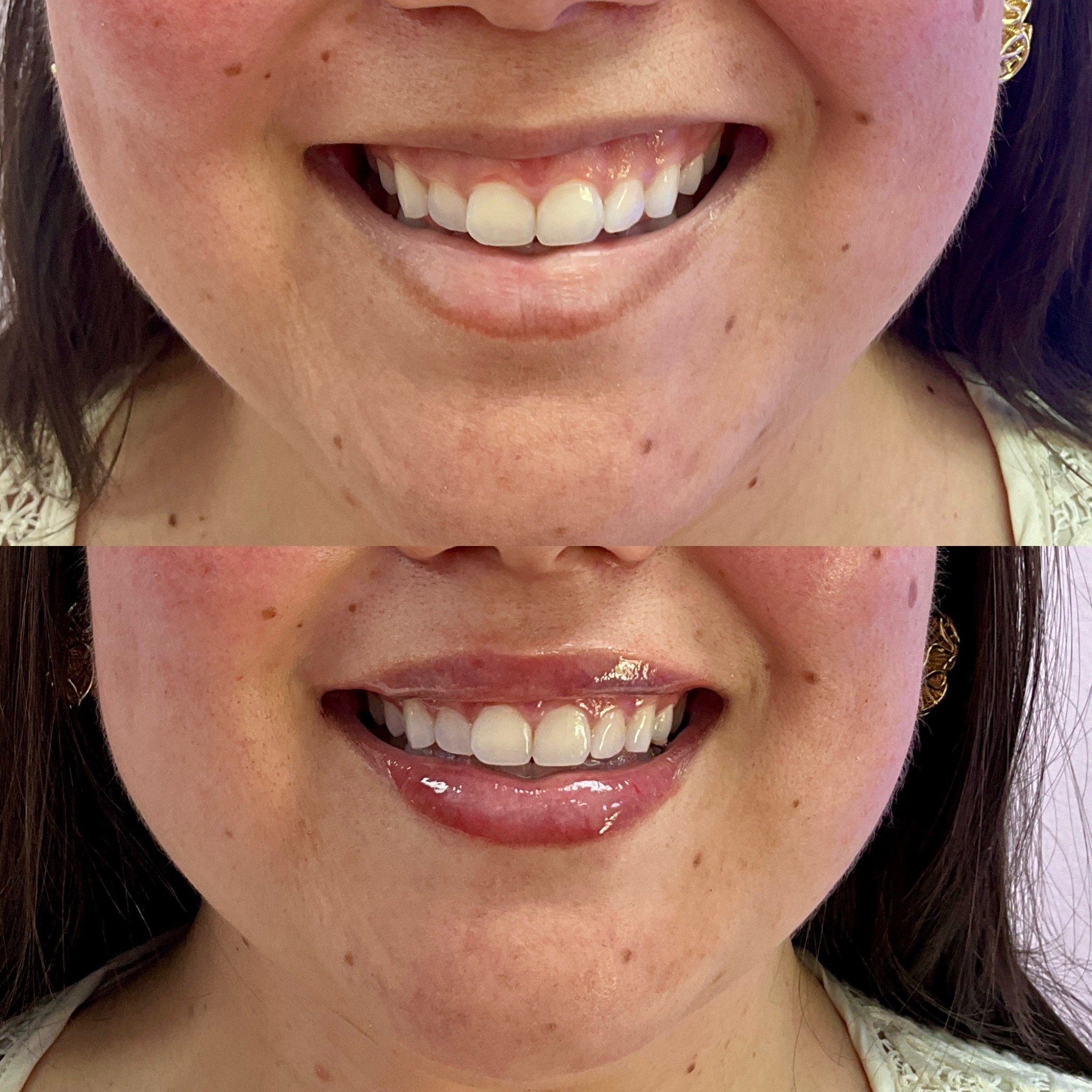 Gummy Smile Lip Treatment