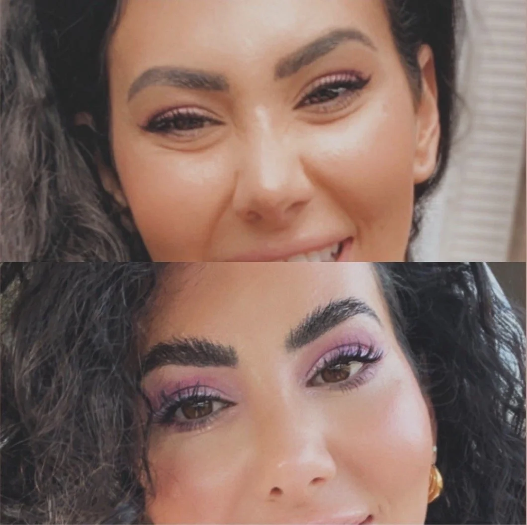 Jelly Roll Tox (undereyes)