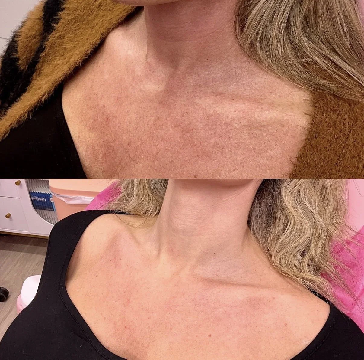 Laser Resurfacing (Lutronic Ultra)