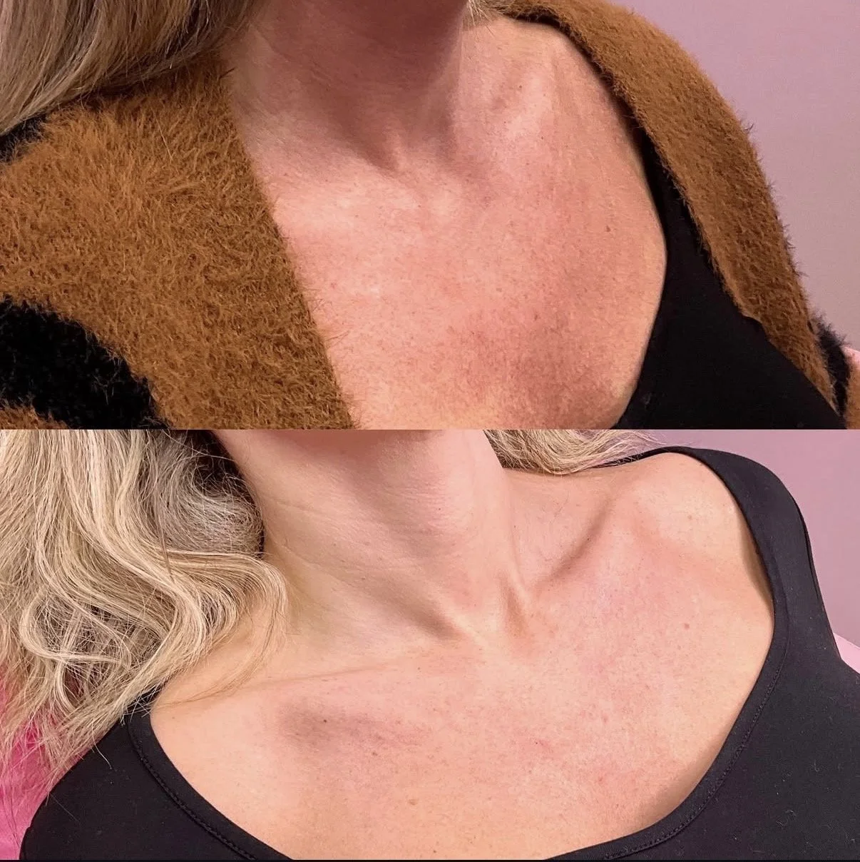 Laser Resurfacing (Lutronic Ultra)