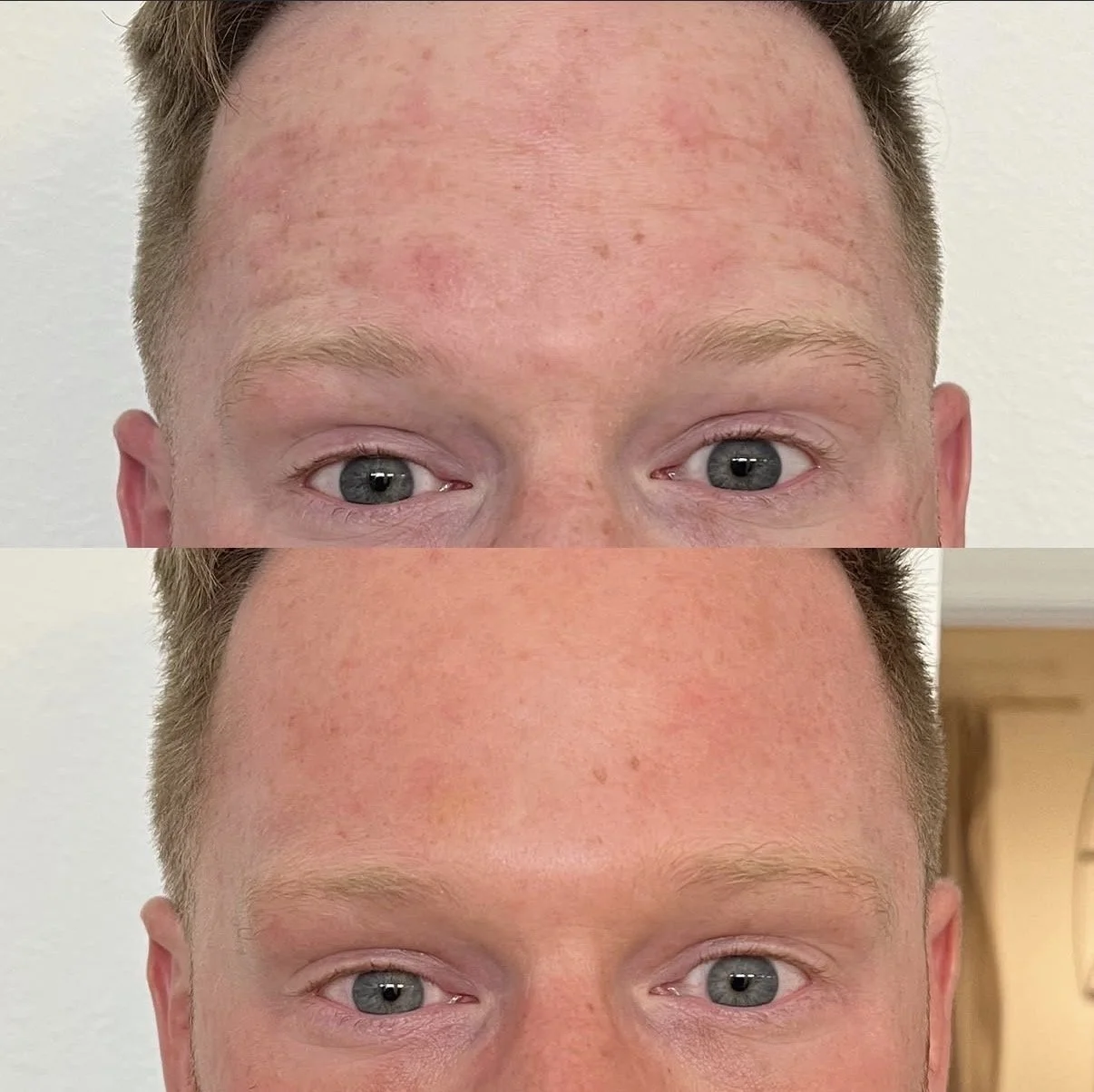 Male Forehead Tox