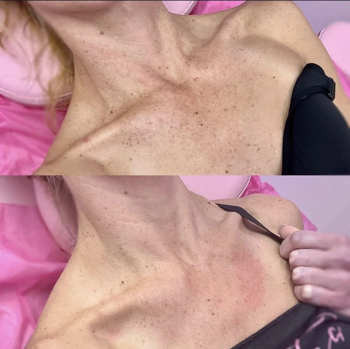 Laser Resurfacing (Lutronic Ultra)