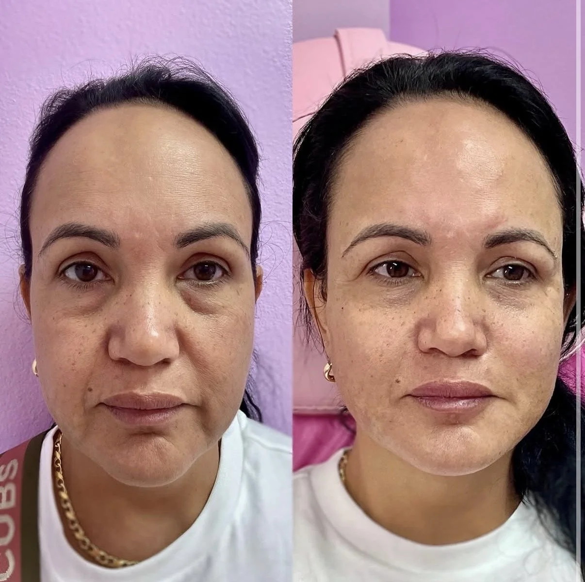 Volume Restoration After Weight Loss