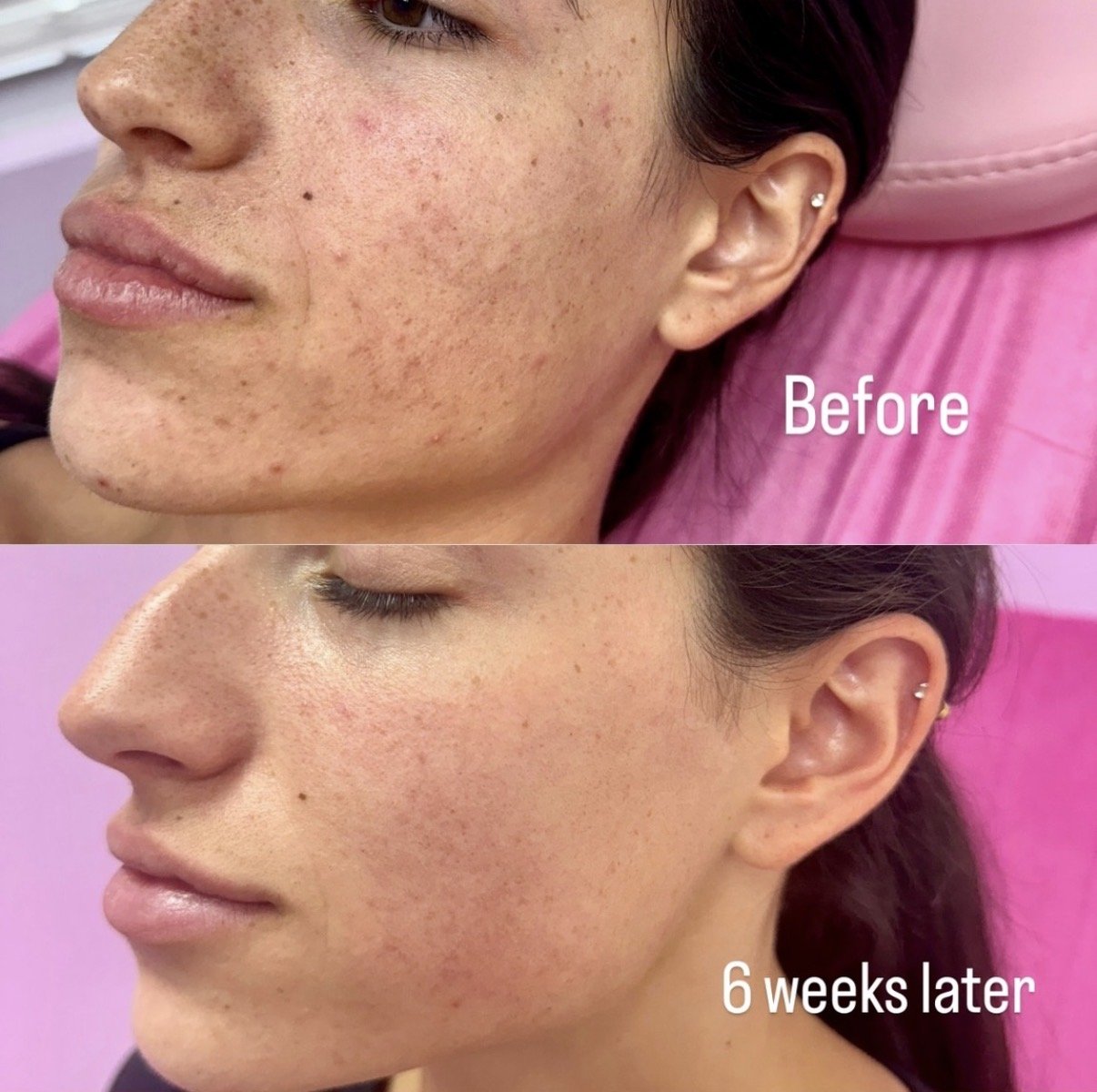 Laser Resurfacing (Lutronic Ultra)