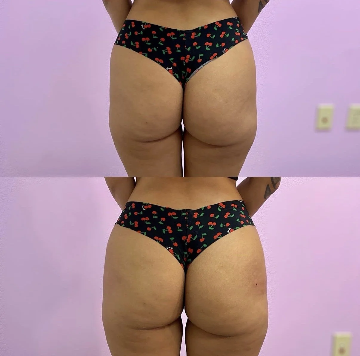 Radiesse BBL (Brazilian Butt Lift)
