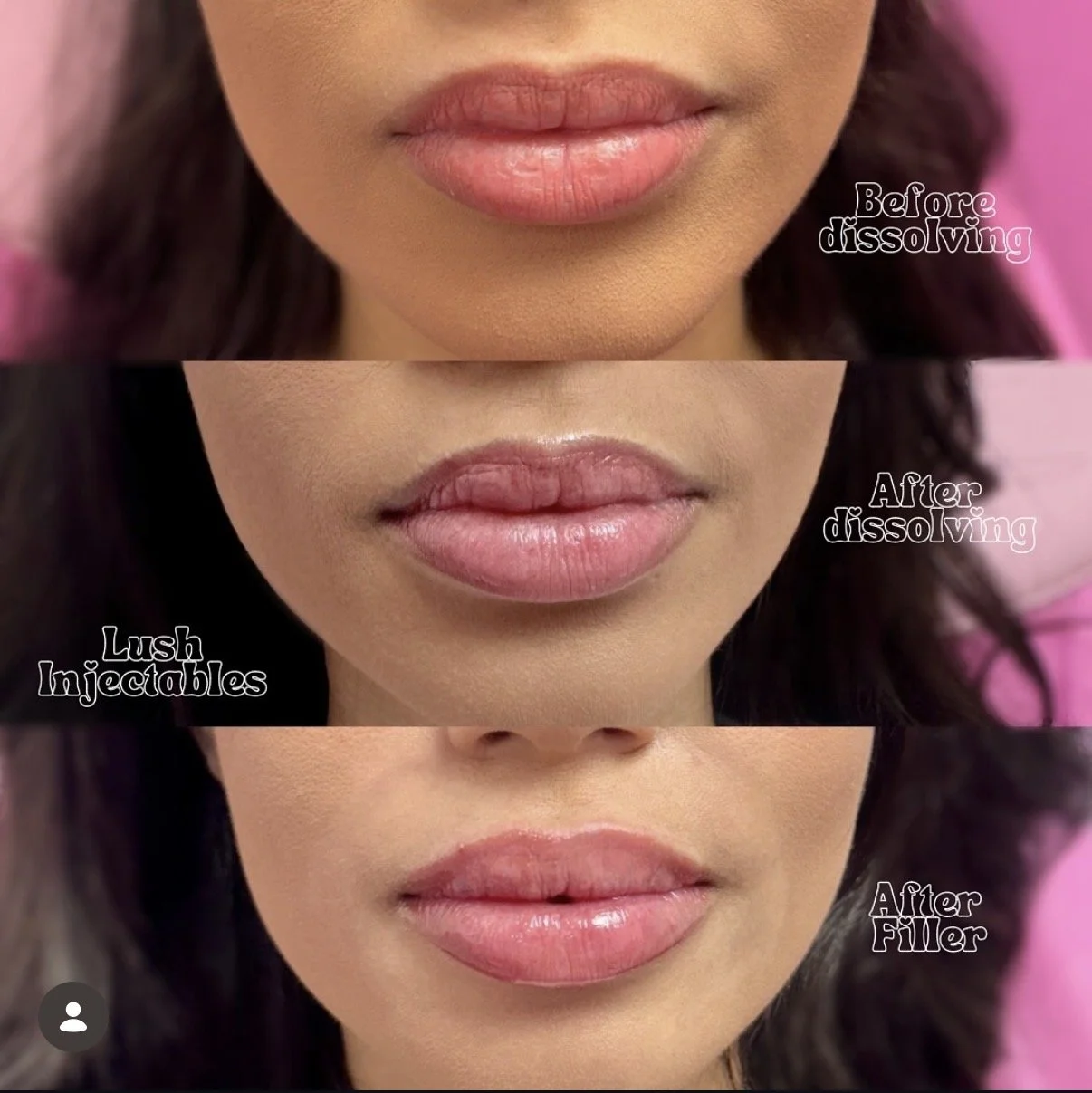 Filler Dissolve and Lush Petite Lip