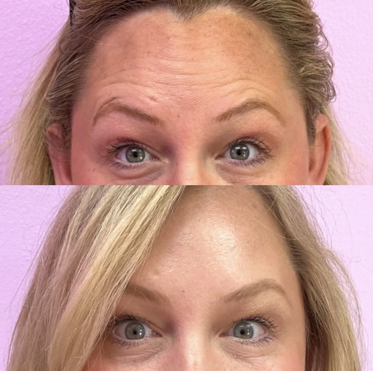 Upper Face Tox Treatment