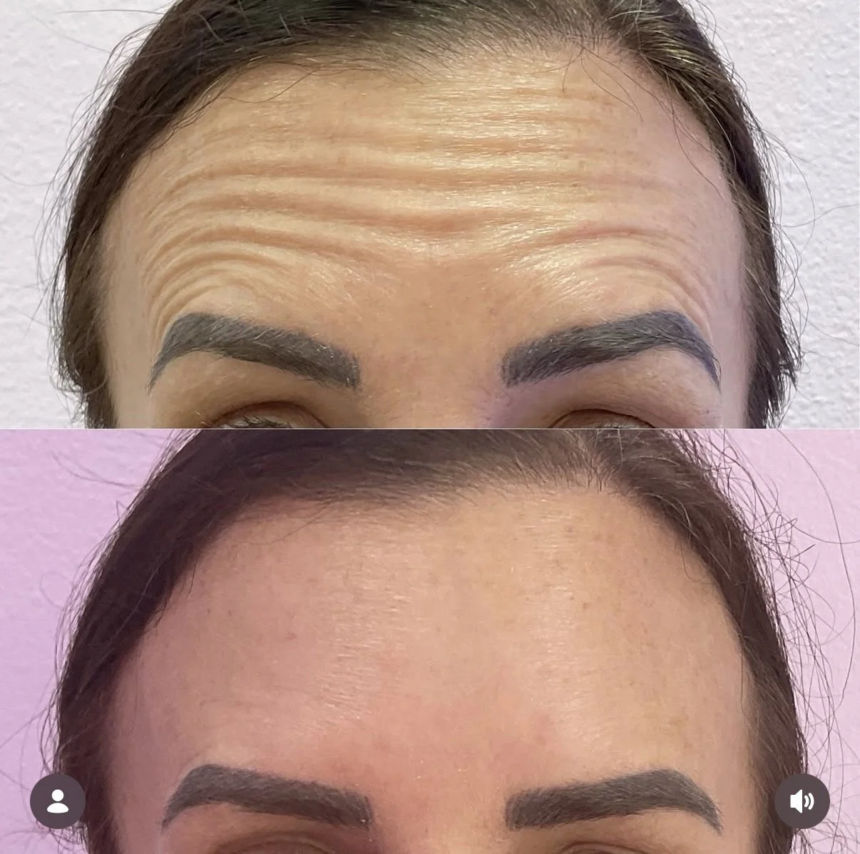 Forehead Tox