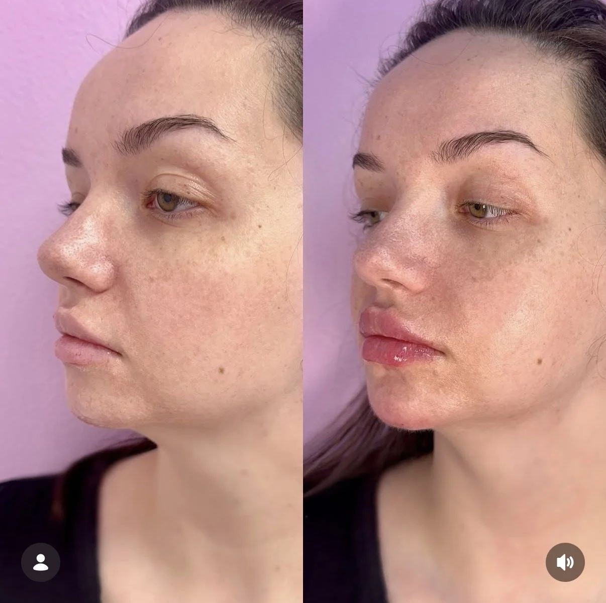 Lip and Chin Combo Treatment