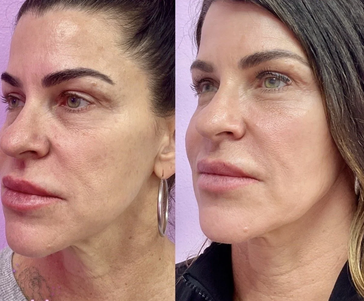 Laser Resurfacing (Vydence DualMode)