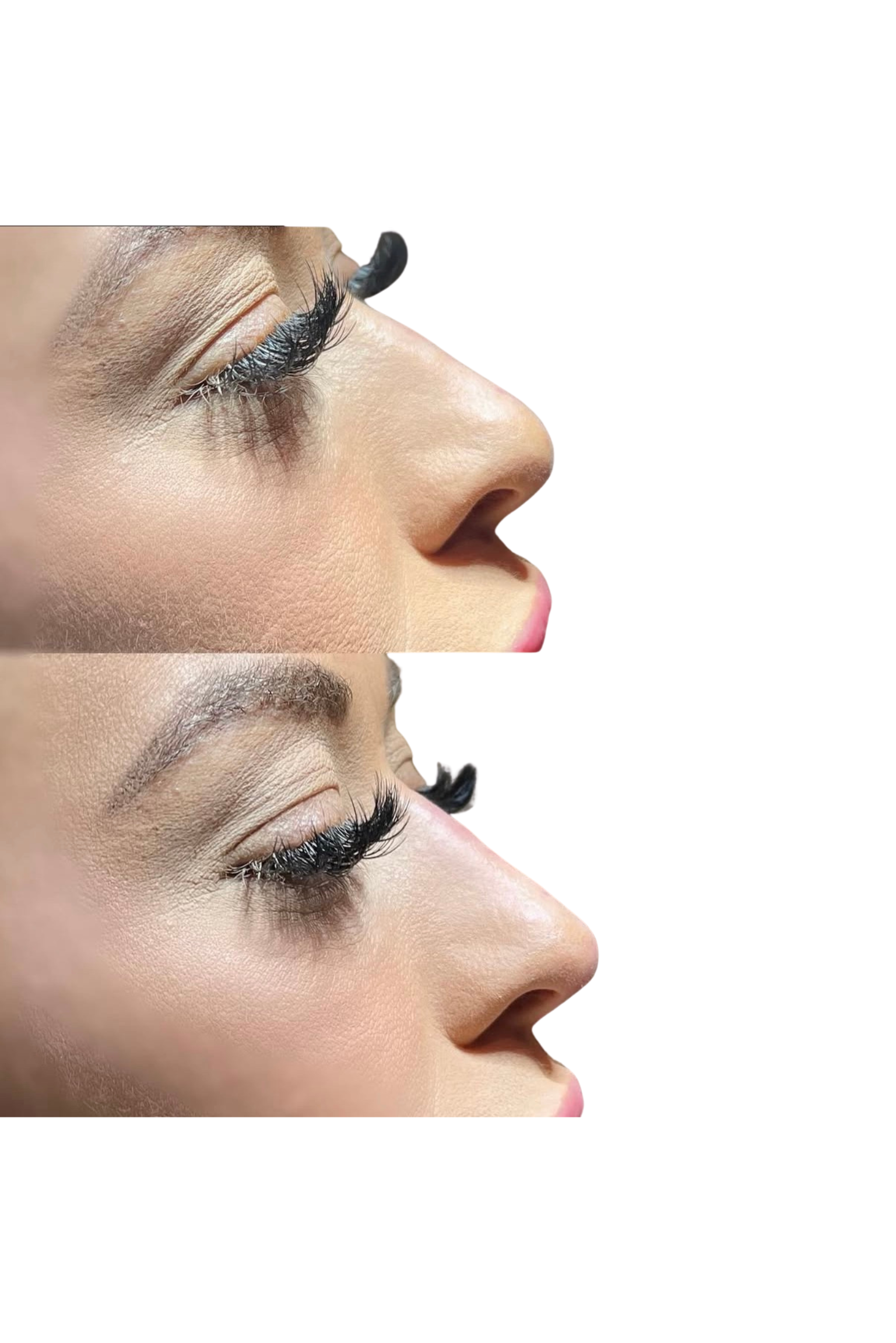 Liquid Rhinoplasty