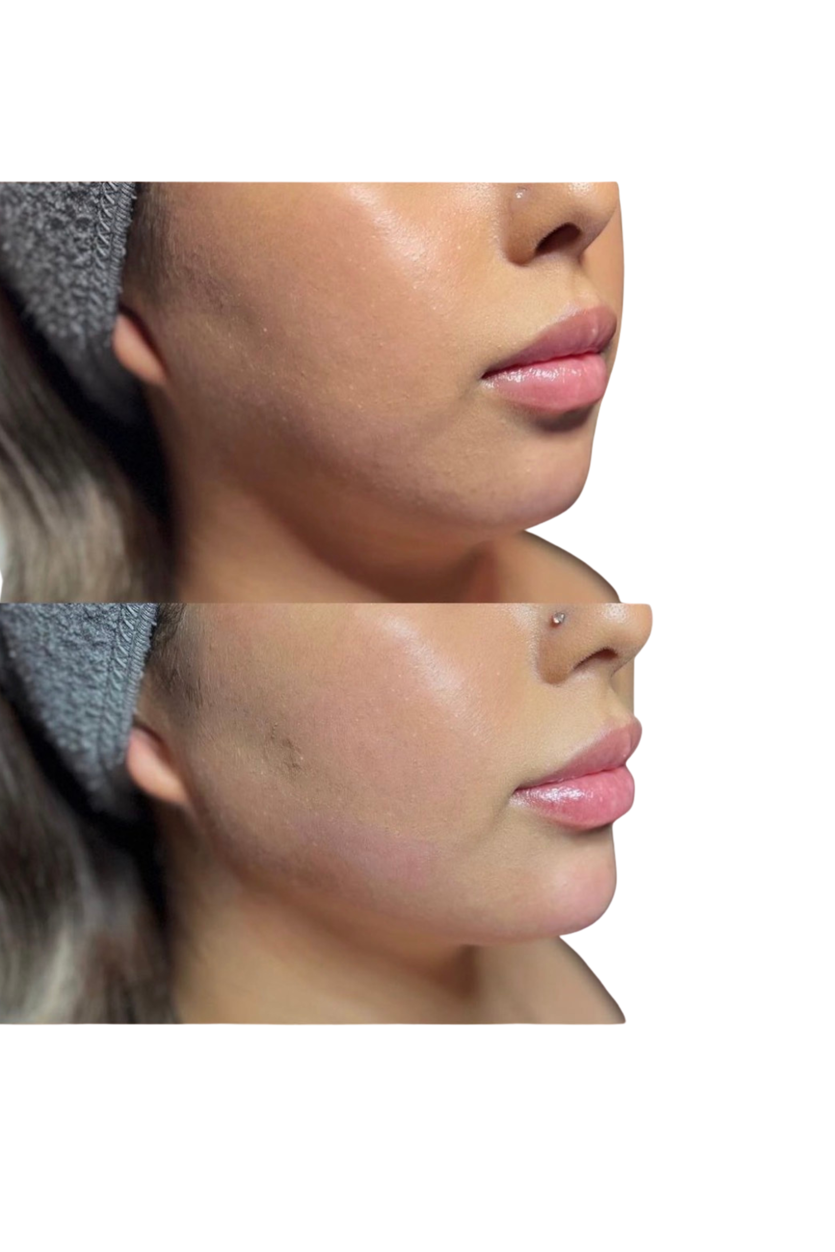 Chin and Jawline Filler