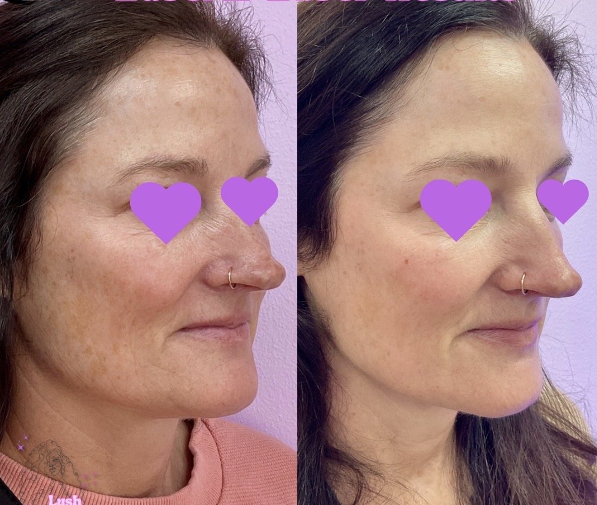 Laser Resurfacing (Lutronic Ultra)