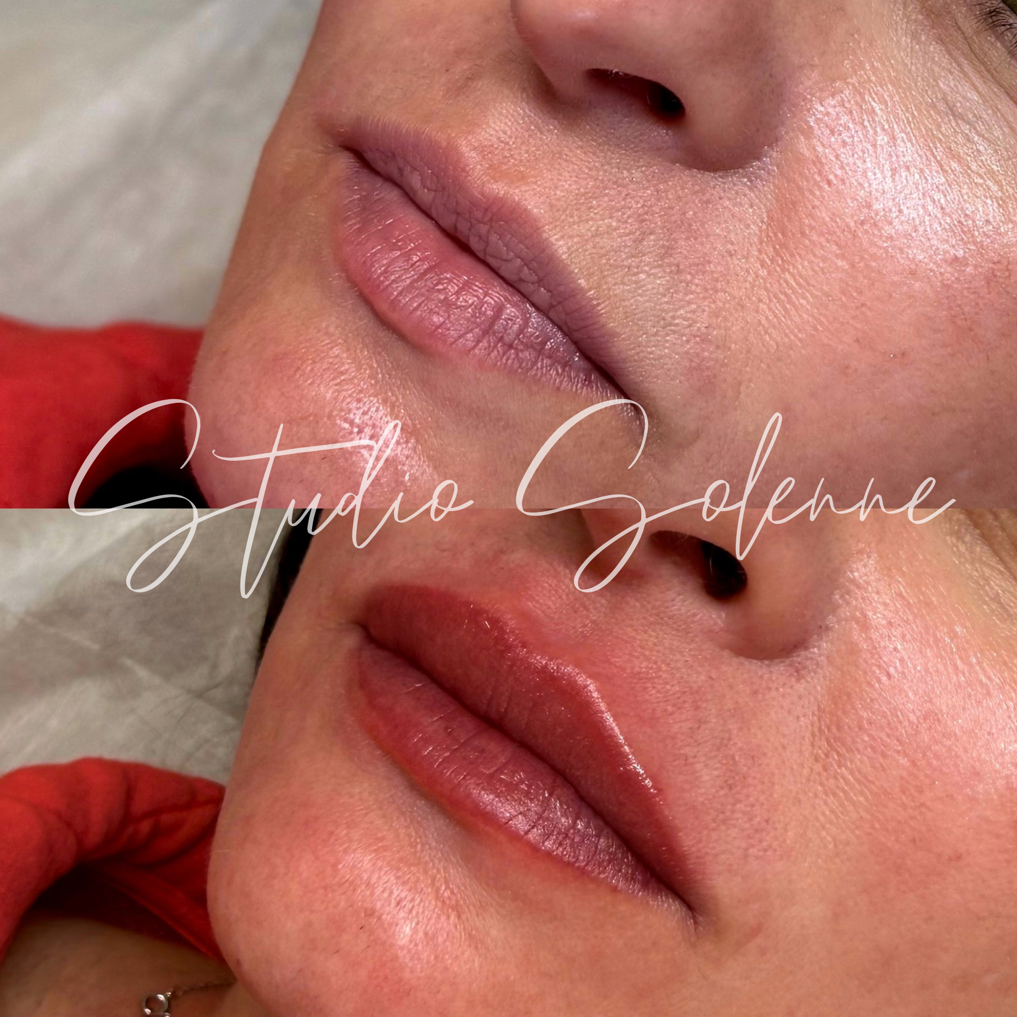Close-up of a person's lips before and after a cosmetic lip enhancement procedure, showing fuller lips with a glossy finish after the treatment.