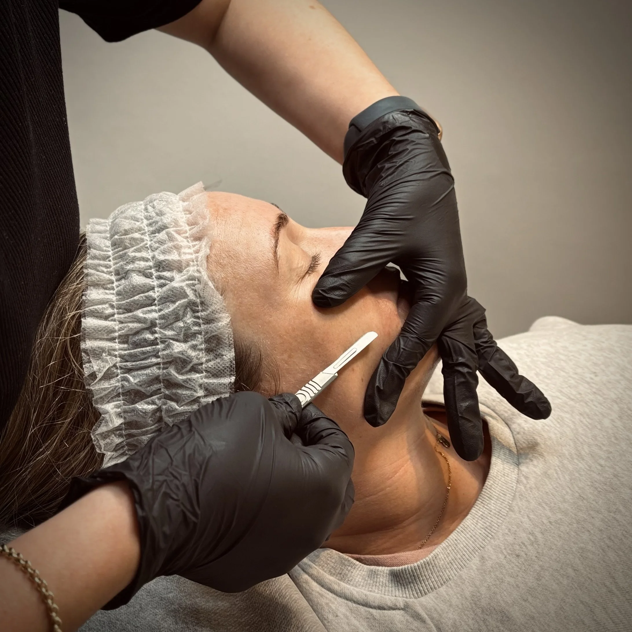 A woman lying down receiving a cosmetic dermaplaning treatment on her face, wearing a hair cap with a healthcare professional wearing black gloves administering the treatment with a precise instrument.