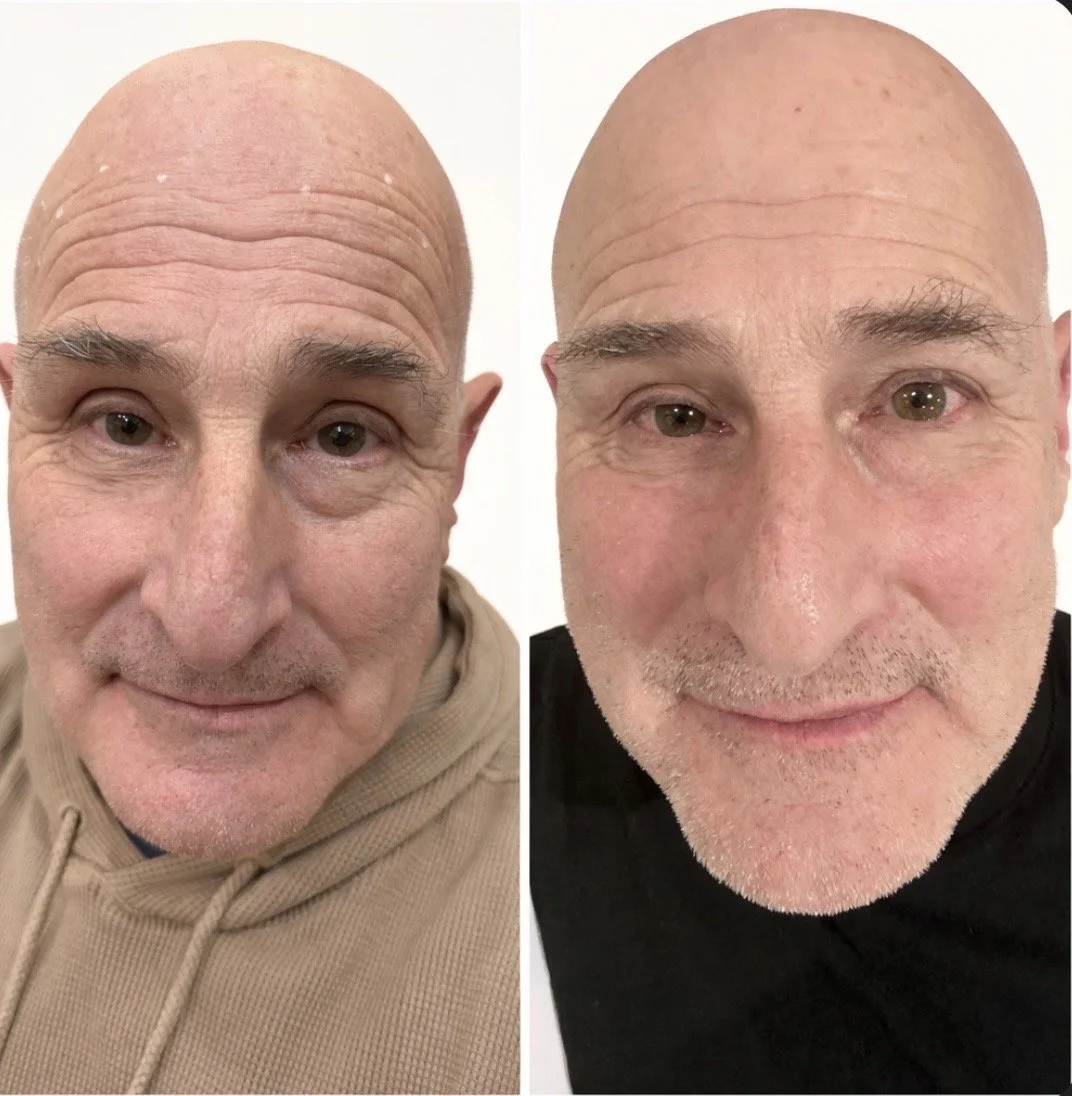 Botox Before And After