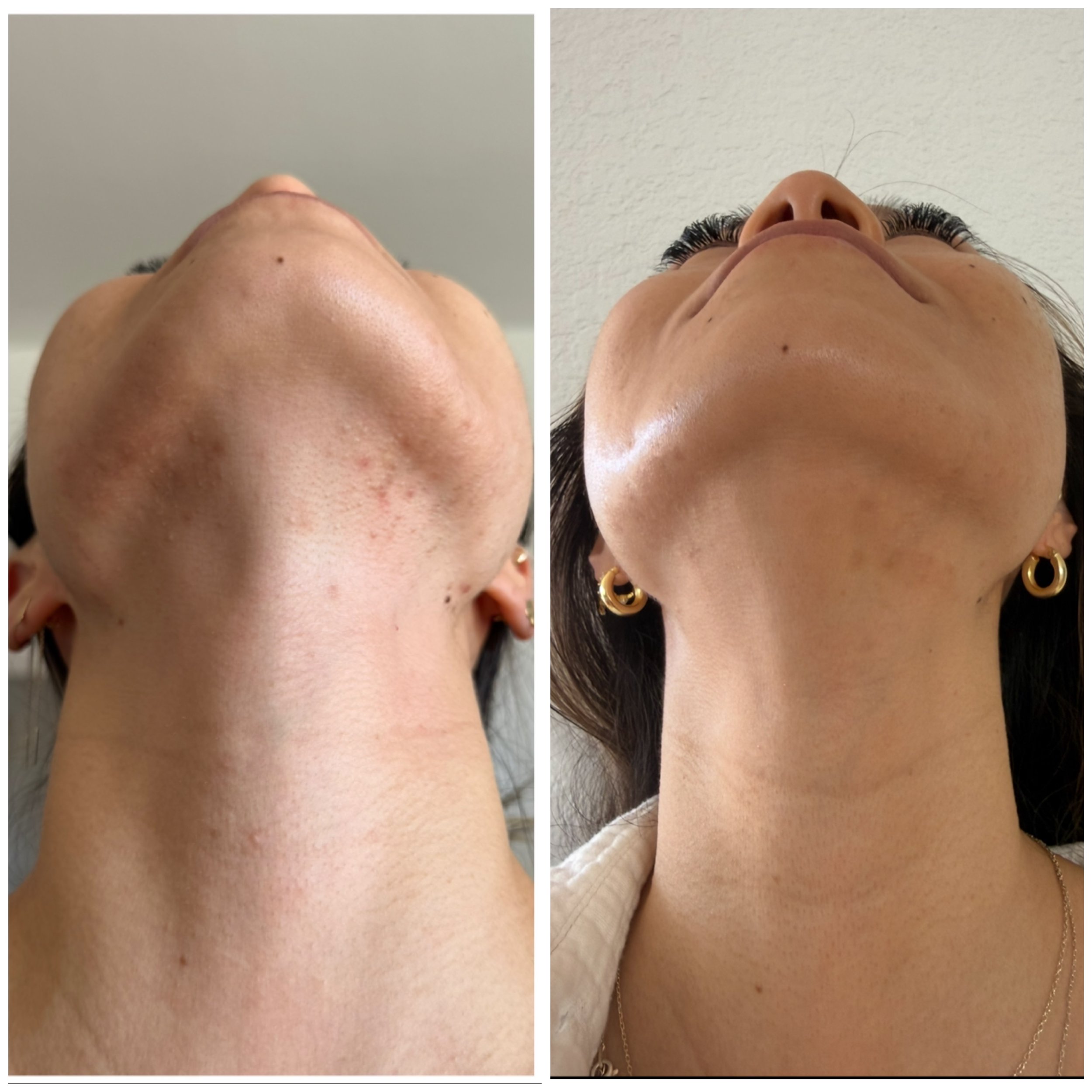 Chemical Peel and Microneedling Before and After
