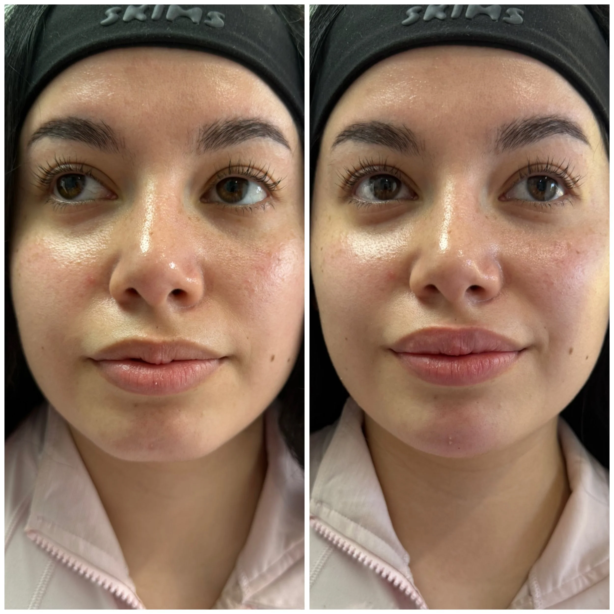 Chin Filler Before and After