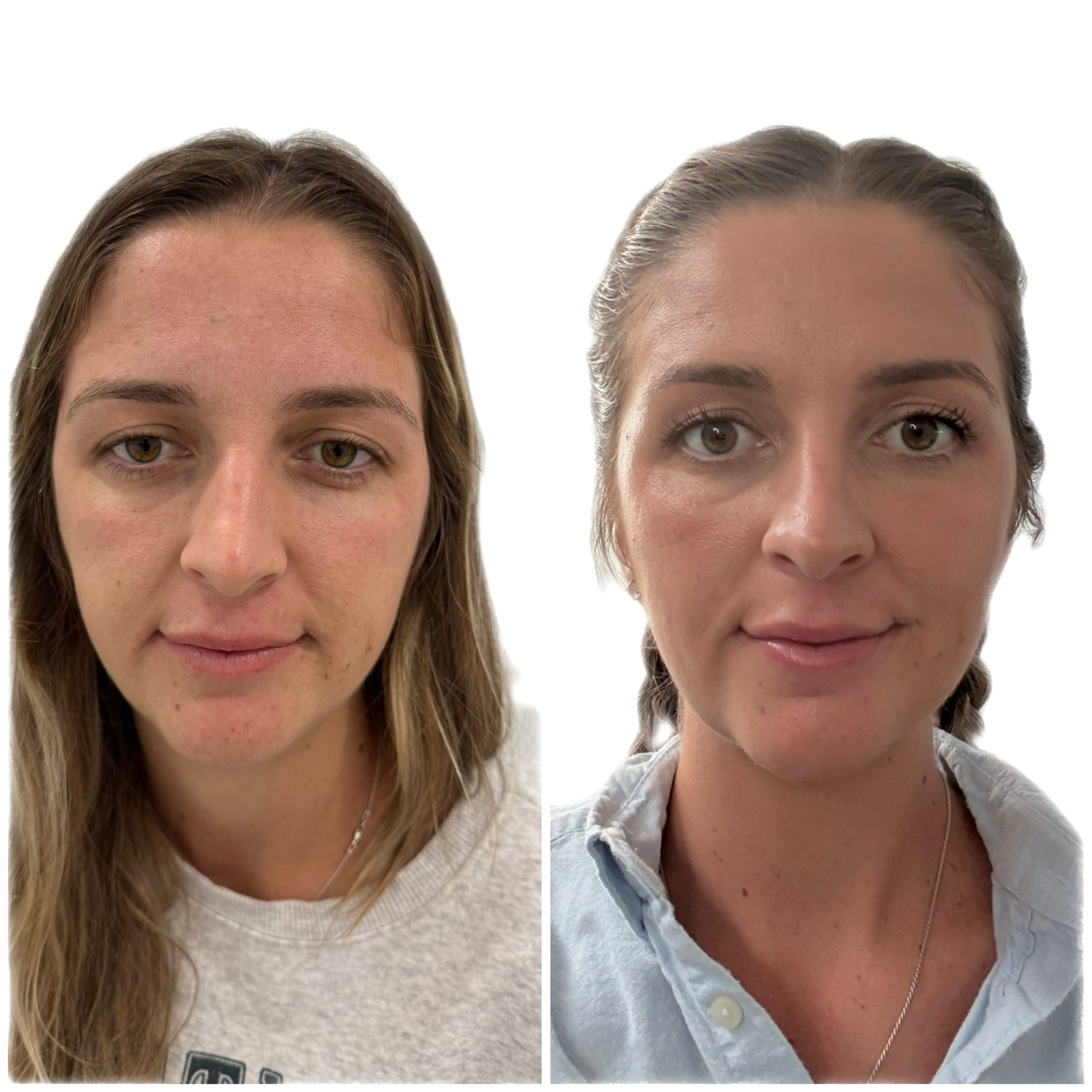 Botox Brow Lift Before and After