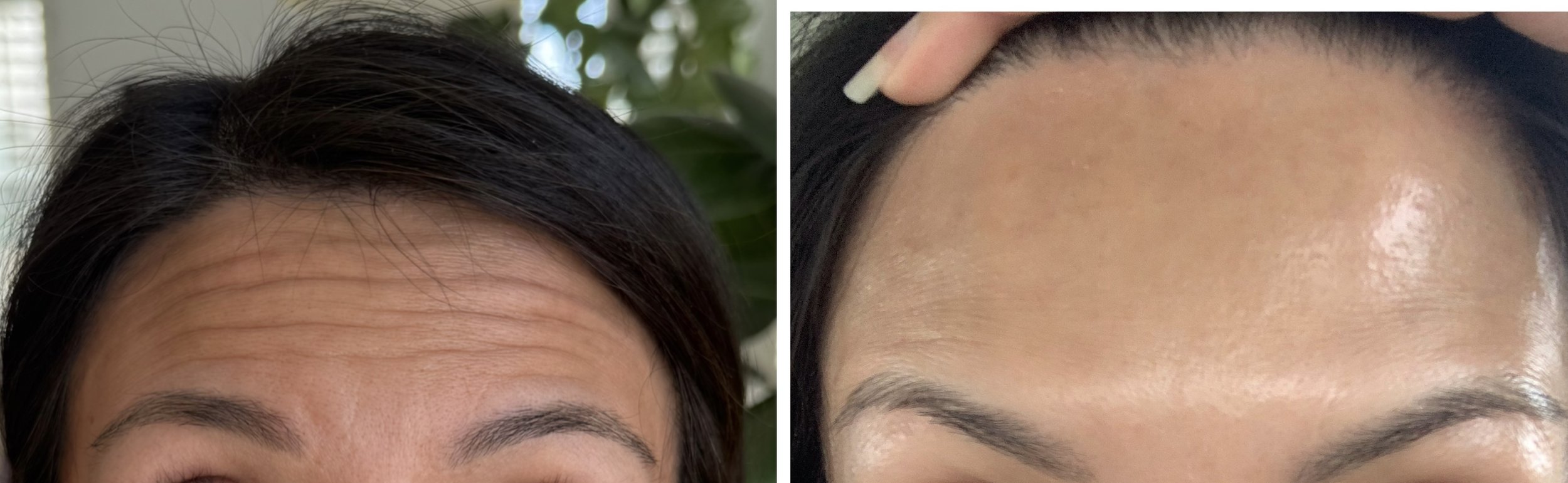 Combination of Botox and Microneedling Before and After