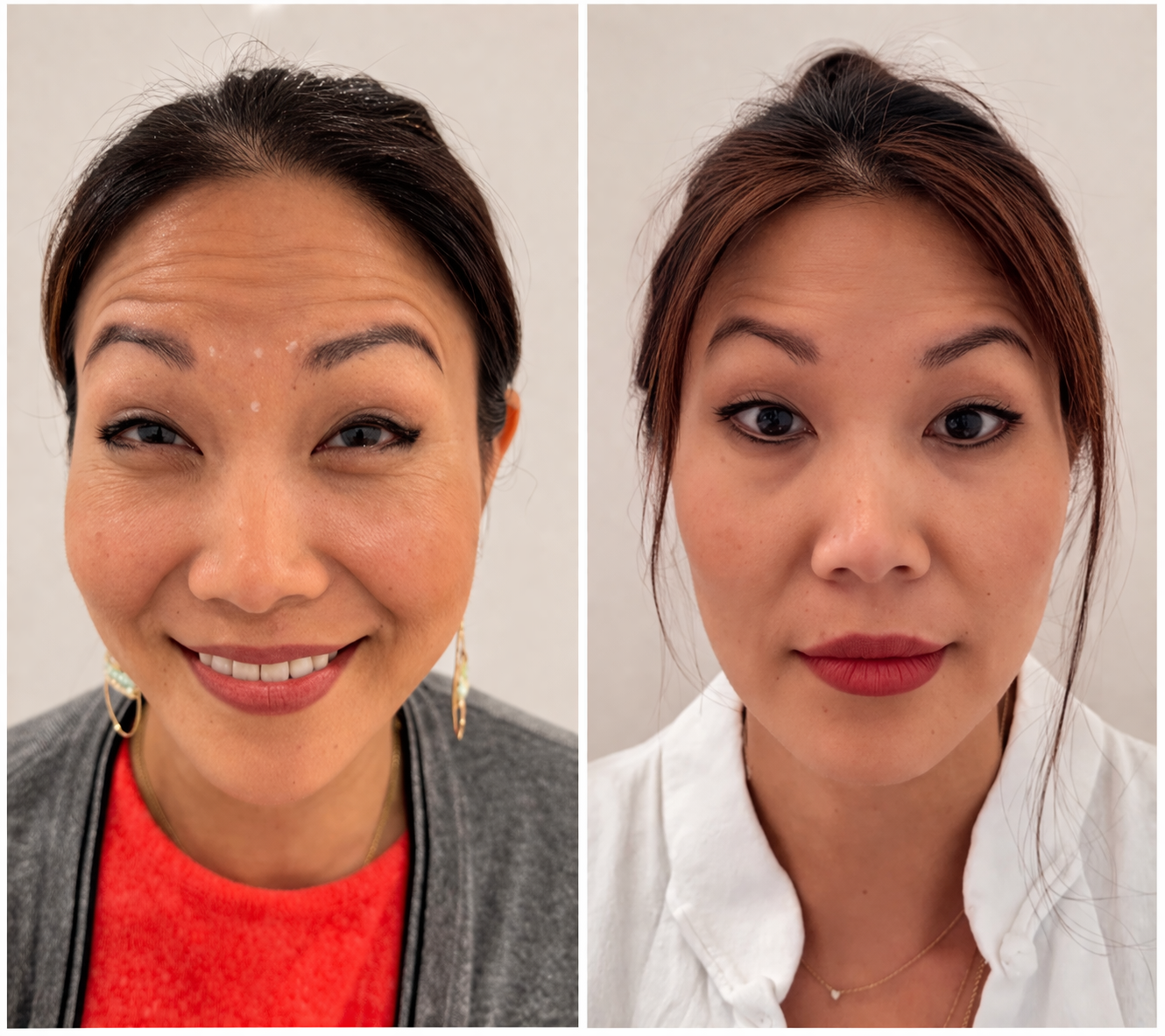 Forehead Botox Before and After 