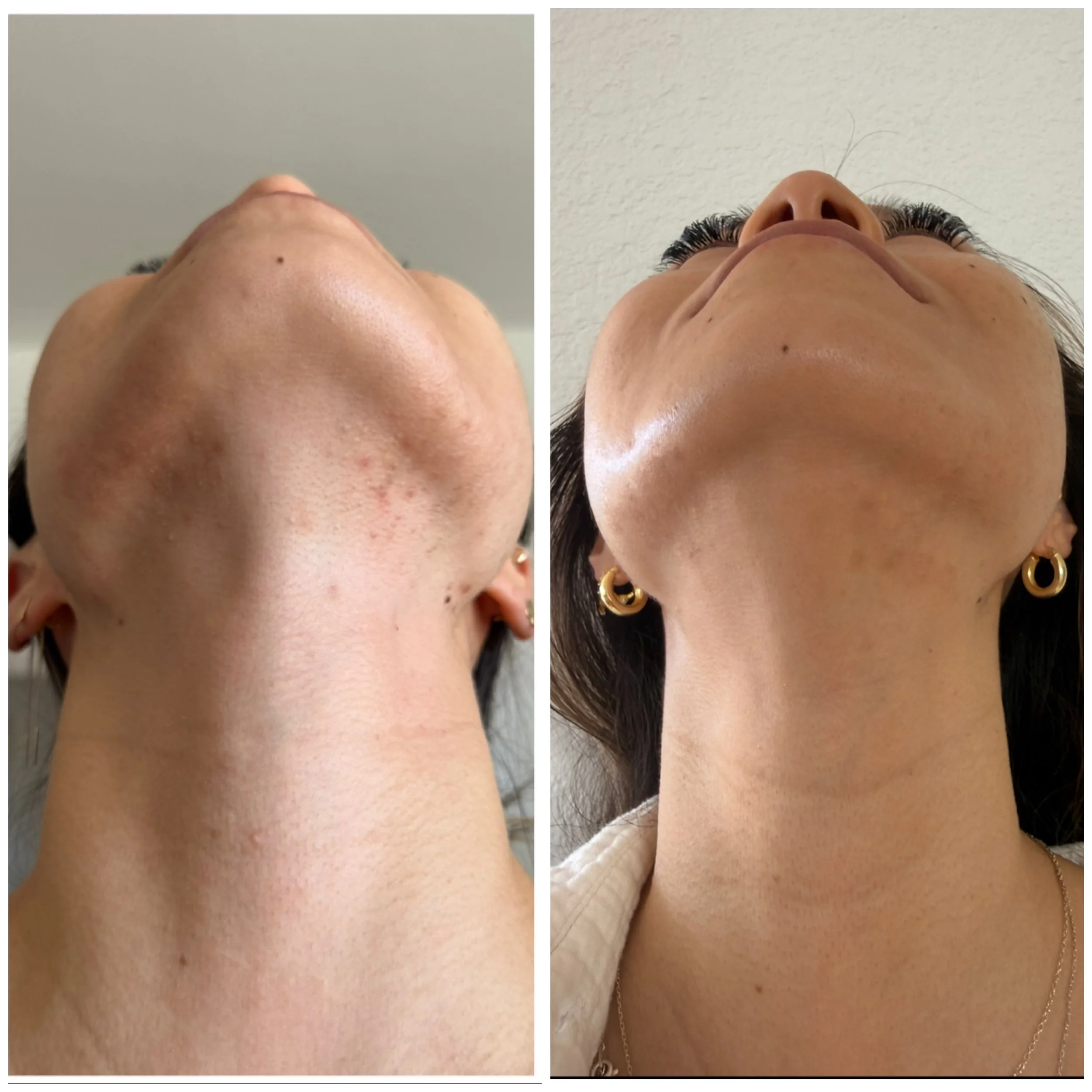 Combination of Microneedling with Chemical Peel Before and After 