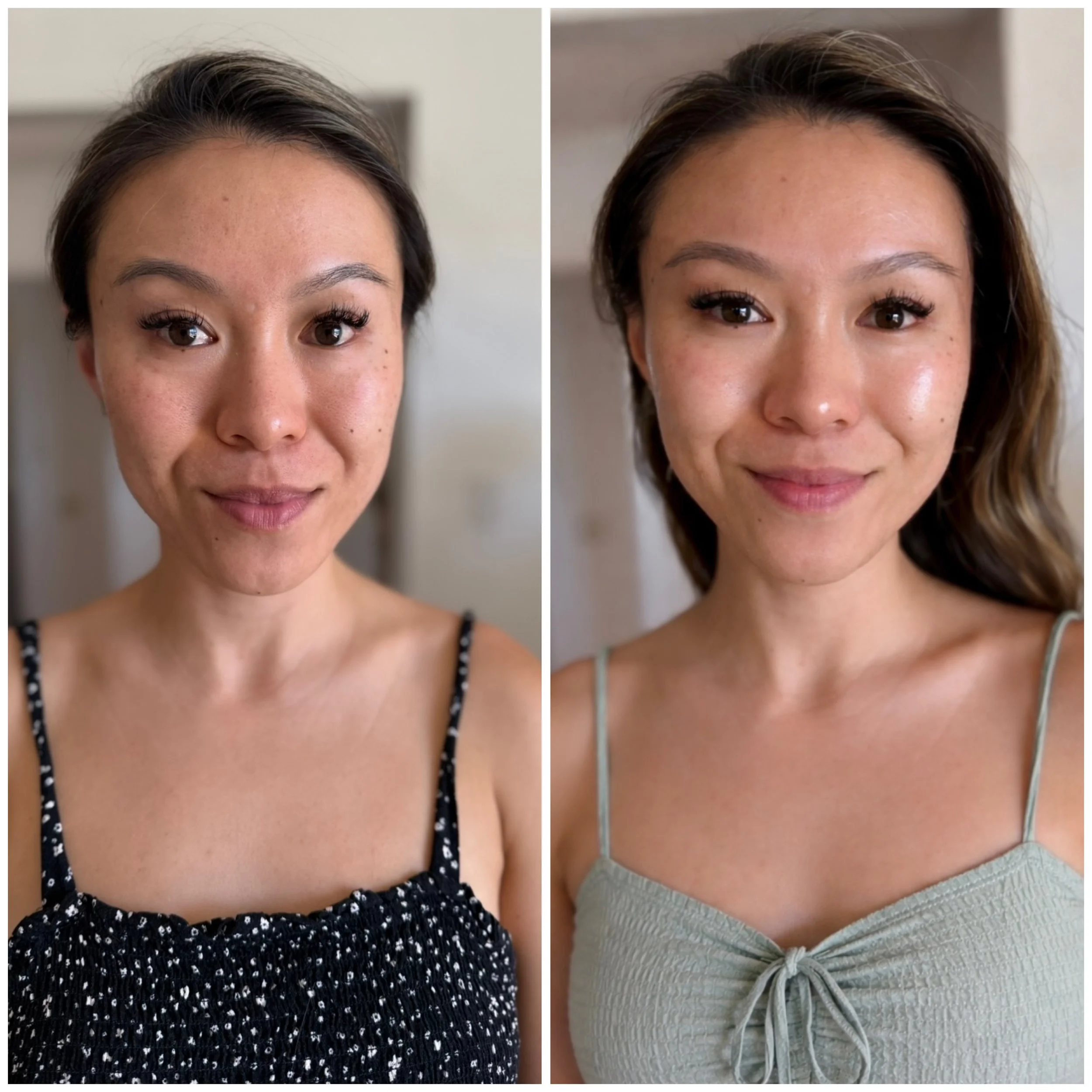 Chemical Peel Before and After 
