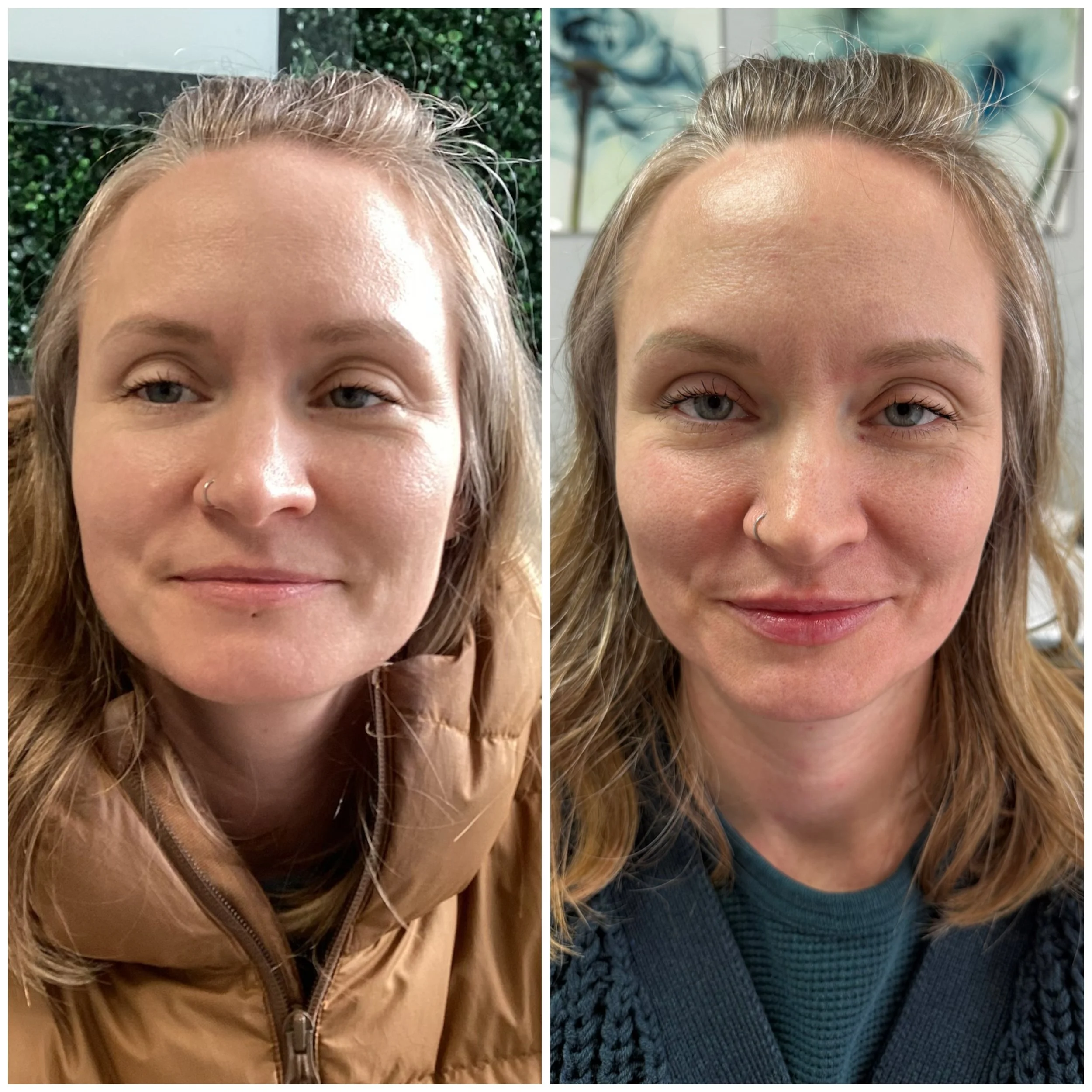 Lip Filler Before and After