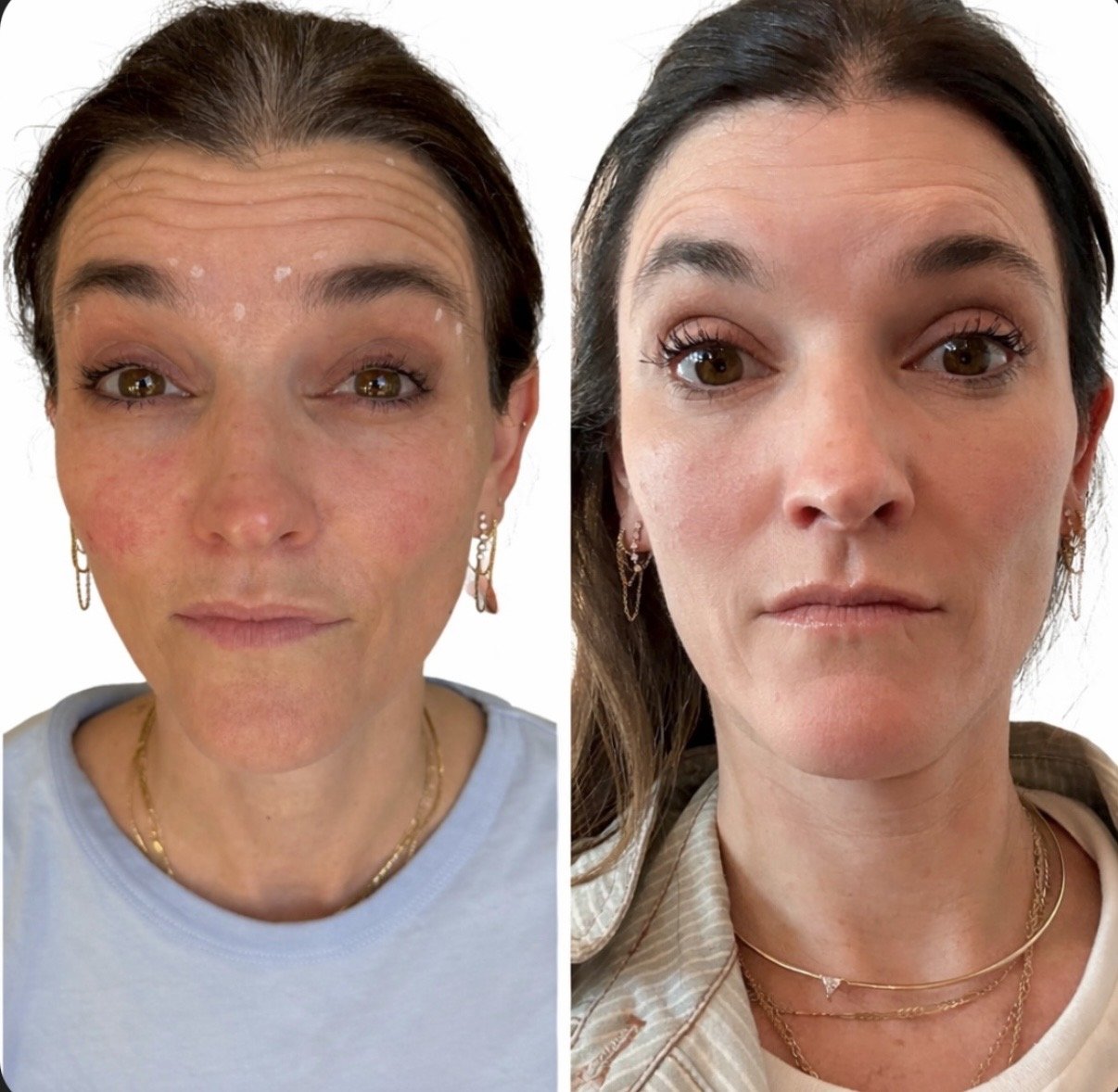 Botox Before and After 