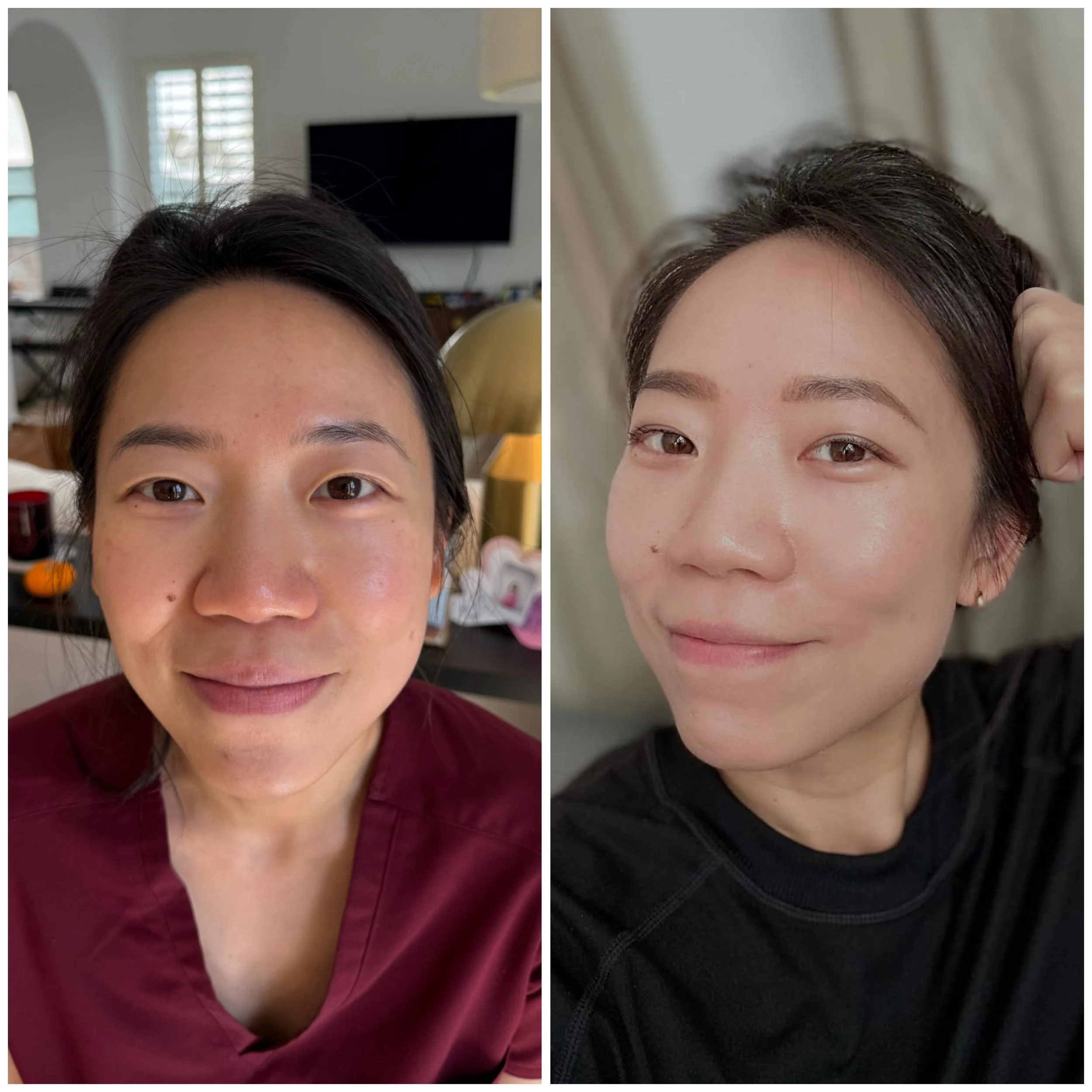Microneedling Before and After 
